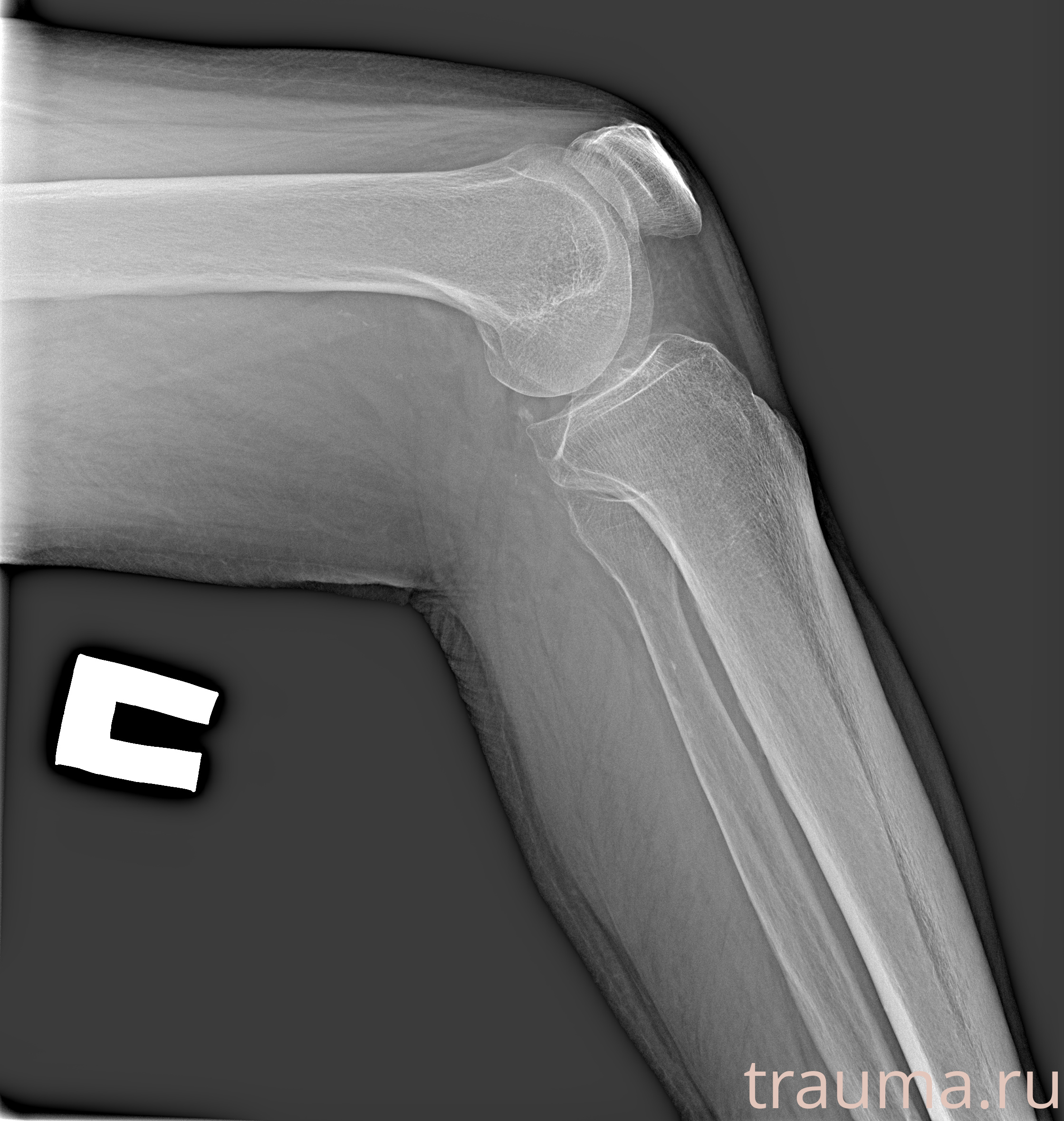 Рентген на дому: по вашему адресу приезжает врач-рентгенолог, травматолог-ортопед с мобильным рентгеновским аппаратом, проводит диагностику травмы или заболевания, делает необходимые рентгенограммы, дает рекомендации по дальнейшему лечению. Получить качественные снимки в домашних условиях возможно благодаря уникальной методике, разработанной МосРентген Центром для института  Склифосовского