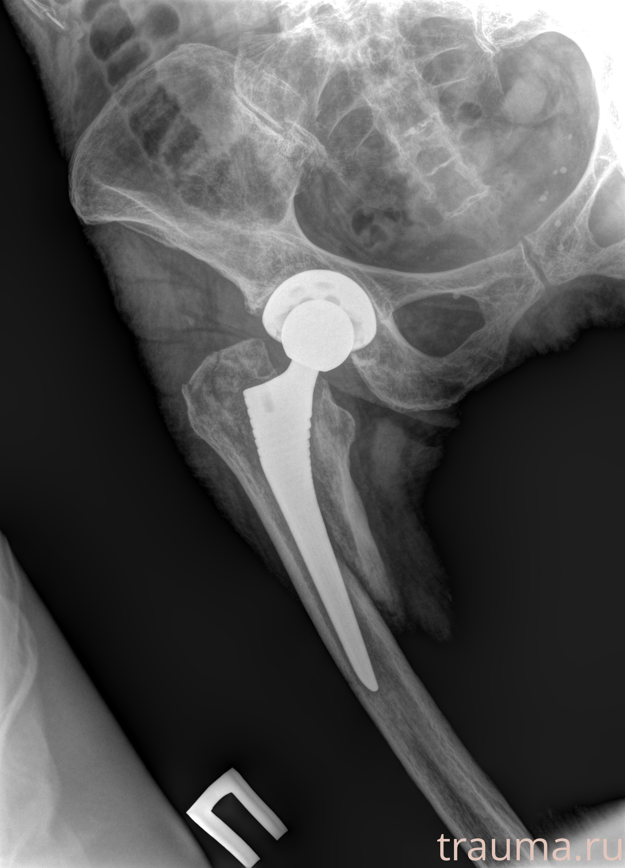 Рентген на дому: по вашему адресу приезжает врач-рентгенолог, травматолог-ортопед с мобильным рентгеновским аппаратом, проводит диагностику травмы или заболевания, делает необходимые рентгенограммы, дает рекомендации по дальнейшему лечению. Получить качественные снимки в домашних условиях возможно благодаря уникальной методике, разработанной МосРентген Центром для института  Склифосовского