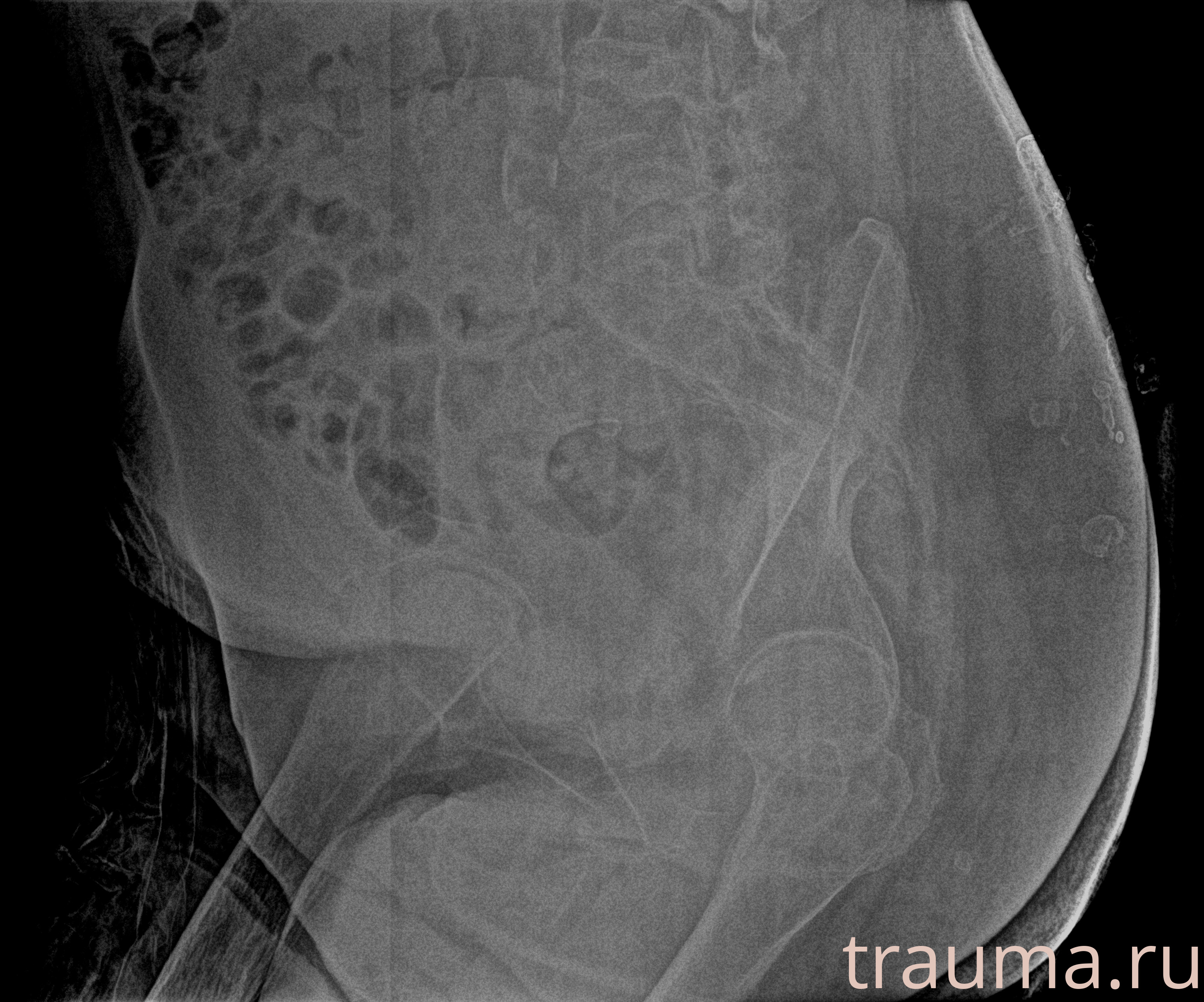 Рентген на дому: по вашему адресу приезжает врач-рентгенолог, травматолог-ортопед с мобильным рентгеновским аппаратом, проводит диагностику травмы или заболевания, делает необходимые рентгенограммы, дает рекомендации по дальнейшему лечению. Получить качественные снимки в домашних условиях возможно благодаря уникальной методике, разработанной МосРентген Центром для института  Склифосовского