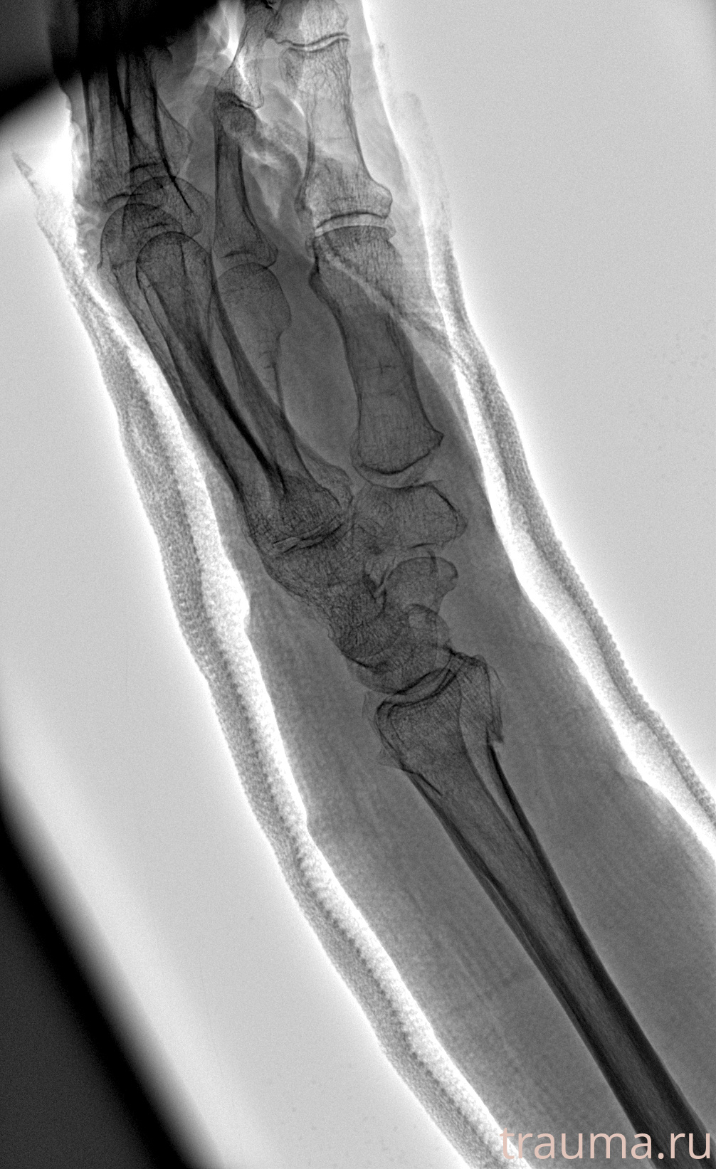 Рентген на дому: по вашему адресу приезжает врач-рентгенолог, травматолог-ортопед с мобильным рентгеновским аппаратом, проводит диагностику травмы или заболевания, делает необходимые рентгенограммы, дает рекомендации по дальнейшему лечению. Получить качественные снимки в домашних условиях возможно благодаря уникальной методике, разработанной МосРентген Центром для института  Склифосовского