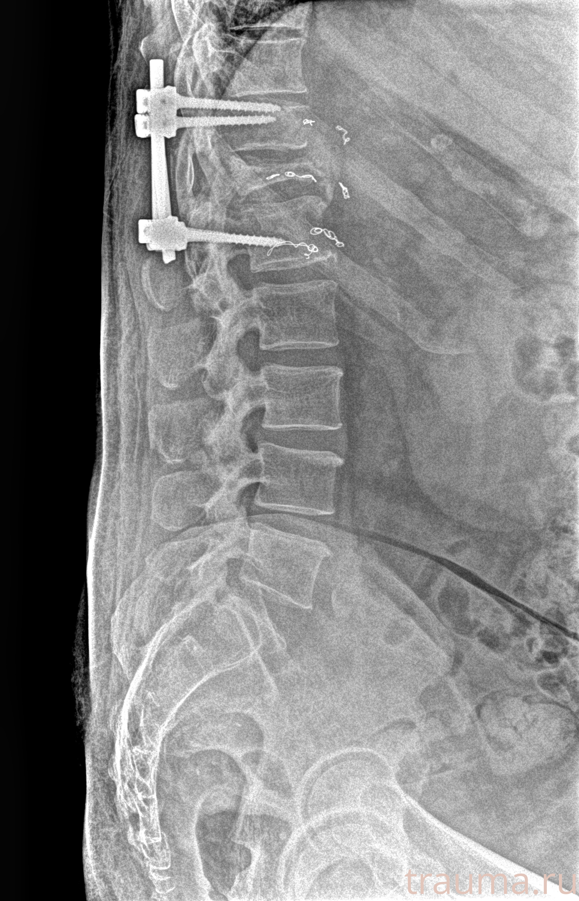 Рентген на дому: по вашему адресу приезжает врач-рентгенолог, травматолог-ортопед с мобильным рентгеновским аппаратом, проводит диагностику травмы или заболевания, делает необходимые рентгенограммы, дает рекомендации по дальнейшему лечению. Получить качественные снимки в домашних условиях возможно благодаря уникальной методике, разработанной МосРентген Центром для института  Склифосовского
