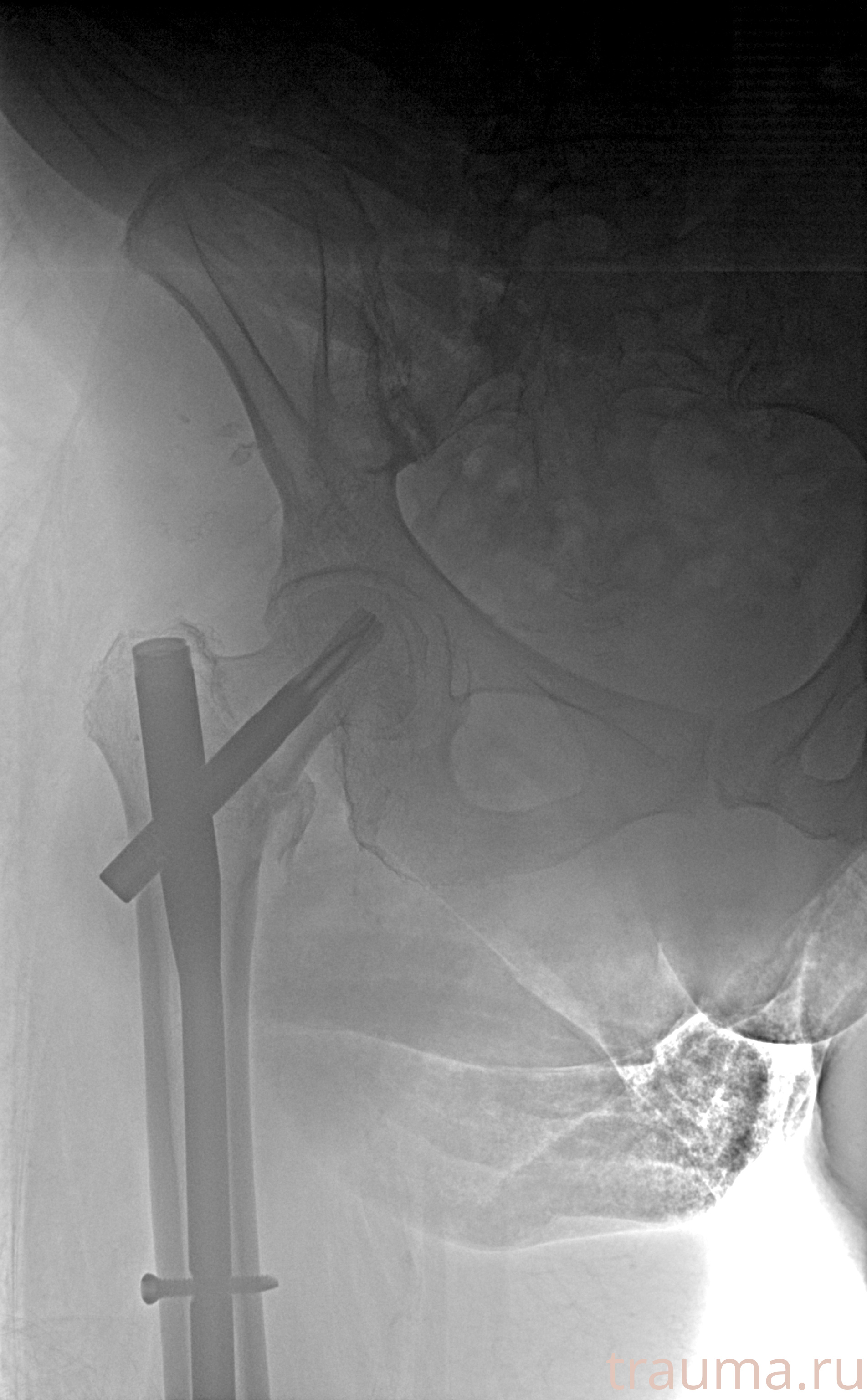 Рентген на дому: по вашему адресу приезжает врач-рентгенолог, травматолог-ортопед с мобильным рентгеновским аппаратом, проводит диагностику травмы или заболевания, делает необходимые рентгенограммы, дает рекомендации по дальнейшему лечению. Получить качественные снимки в домашних условиях возможно благодаря уникальной методике, разработанной МосРентген Центром для института  Склифосовского