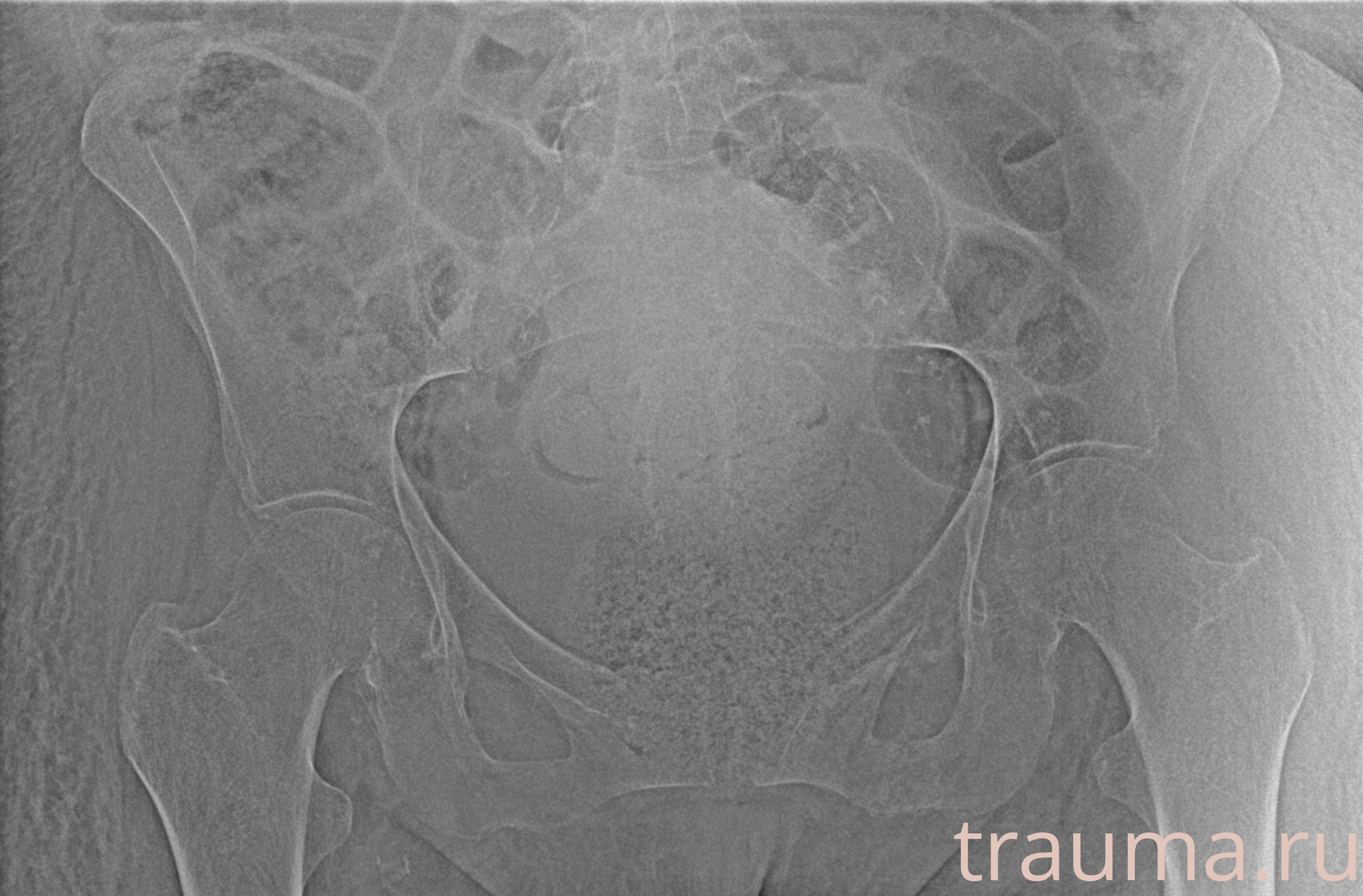 Рентген на дому: по вашему адресу приезжает врач-рентгенолог, травматолог-ортопед с мобильным рентгеновским аппаратом, проводит диагностику травмы или заболевания, делает необходимые рентгенограммы, дает рекомендации по дальнейшему лечению. Получить качественные снимки в домашних условиях возможно благодаря уникальной методике, разработанной МосРентген Центром для института  Склифосовского