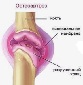 Остеоартроз: факторы риска , патогеноз и современная терапия Остеоартроз: факторы риска , патогеноз и современная терапия