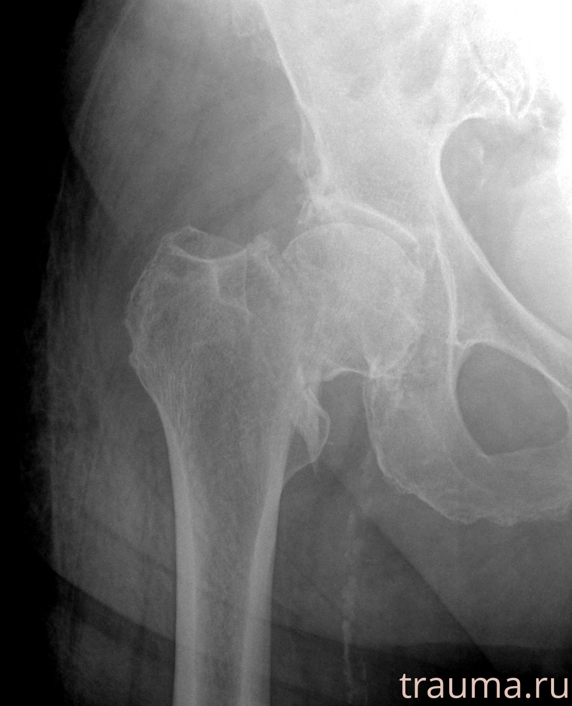 Рентген на дому: по вашему адресу приезжает врач-рентгенолог, травматолог-ортопед с мобильным рентгеновским аппаратом, проводит диагностику травмы или заболевания, делает необходимые рентгенограммы, дает рекомендации по дальнейшему лечению. Получить качественные снимки в домашних условиях возможно благодаря уникальной методике, разработанной МосРентген Центром для института  Склифосовского