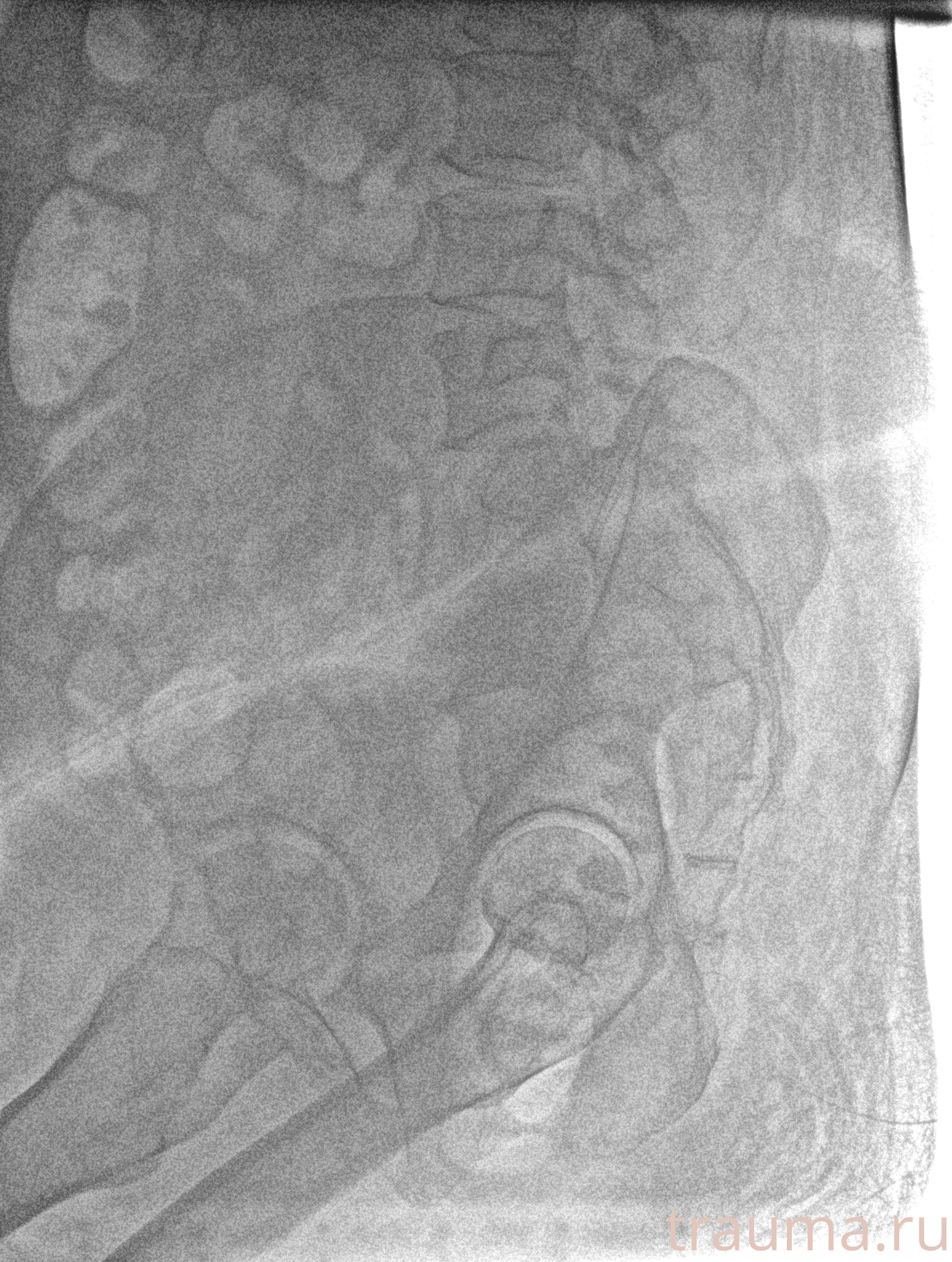 Рентген на дому: по вашему адресу приезжает врач-рентгенолог, травматолог-ортопед с мобильным рентгеновским аппаратом, проводит диагностику травмы или заболевания, делает необходимые рентгенограммы, дает рекомендации по дальнейшему лечению. Получить качественные снимки в домашних условиях возможно благодаря уникальной методике, разработанной МосРентген Центром для института  Склифосовского