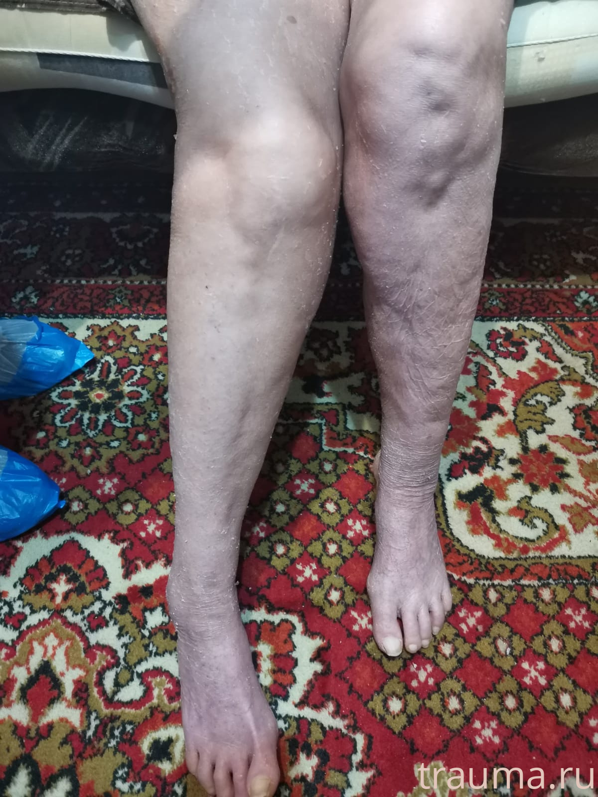 Рентген на дому: по вашему адресу приезжает врач-рентгенолог, травматолог-ортопед с мобильным рентгеновским аппаратом, проводит диагностику травмы или заболевания, делает необходимые рентгенограммы, дает рекомендации по дальнейшему лечению. Получить качественные снимки в домашних условиях возможно благодаря уникальной методике, разработанной МосРентген Центром для института  Склифосовского