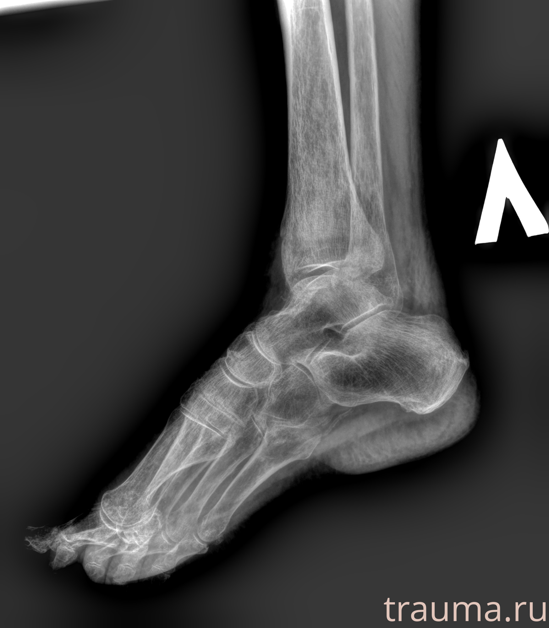 Рентген на дому: по вашему адресу приезжает врач-рентгенолог, травматолог-ортопед с мобильным рентгеновским аппаратом, проводит диагностику травмы или заболевания, делает необходимые рентгенограммы, дает рекомендации по дальнейшему лечению. Получить качественные снимки в домашних условиях возможно благодаря уникальной методике, разработанной МосРентген Центром для института  Склифосовского