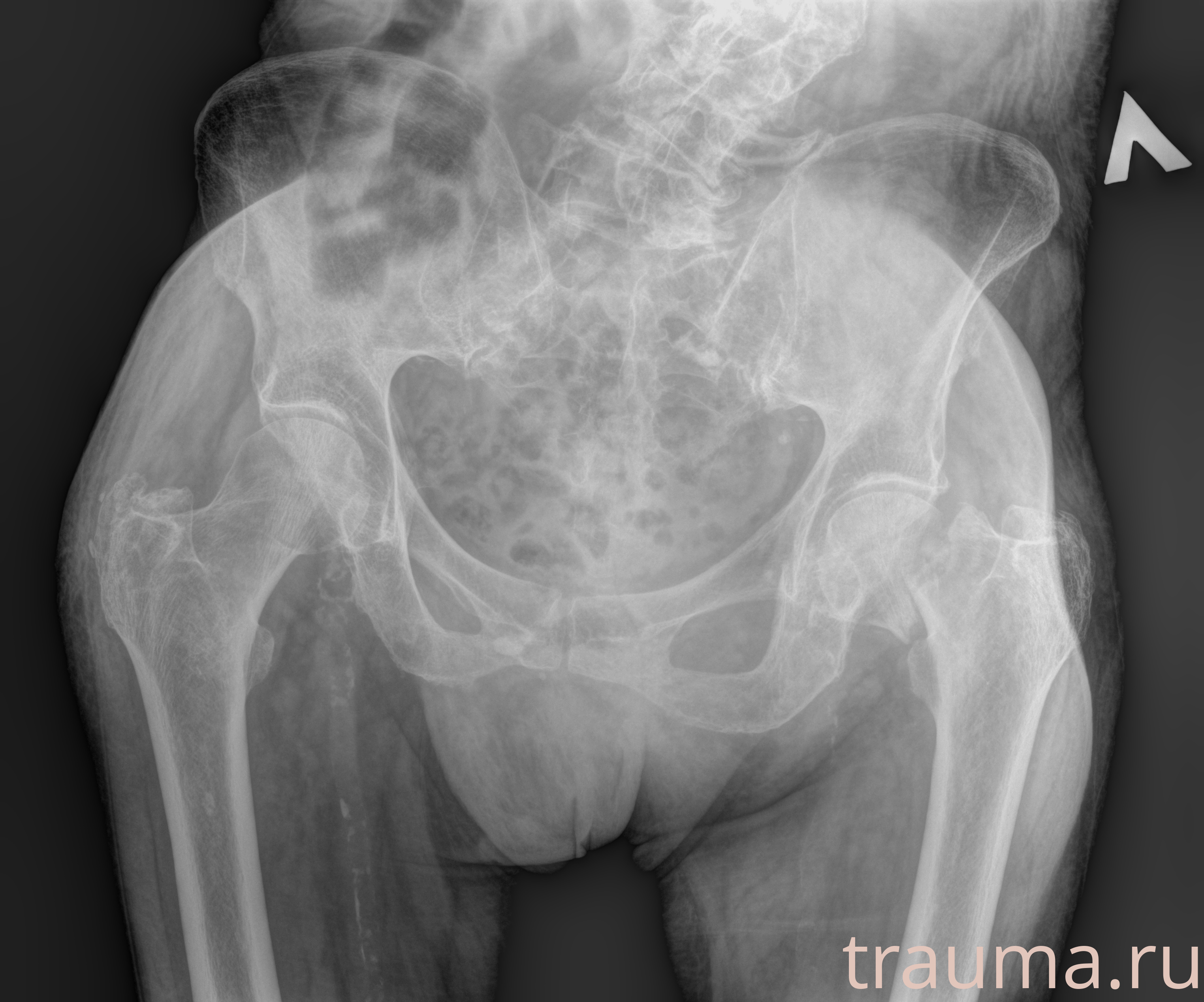 Рентген на дому: по вашему адресу приезжает врач-рентгенолог, травматолог-ортопед с мобильным рентгеновским аппаратом, проводит диагностику травмы или заболевания, делает необходимые рентгенограммы, дает рекомендации по дальнейшему лечению. Получить качественные снимки в домашних условиях возможно благодаря уникальной методике, разработанной МосРентген Центром для института  Склифосовского