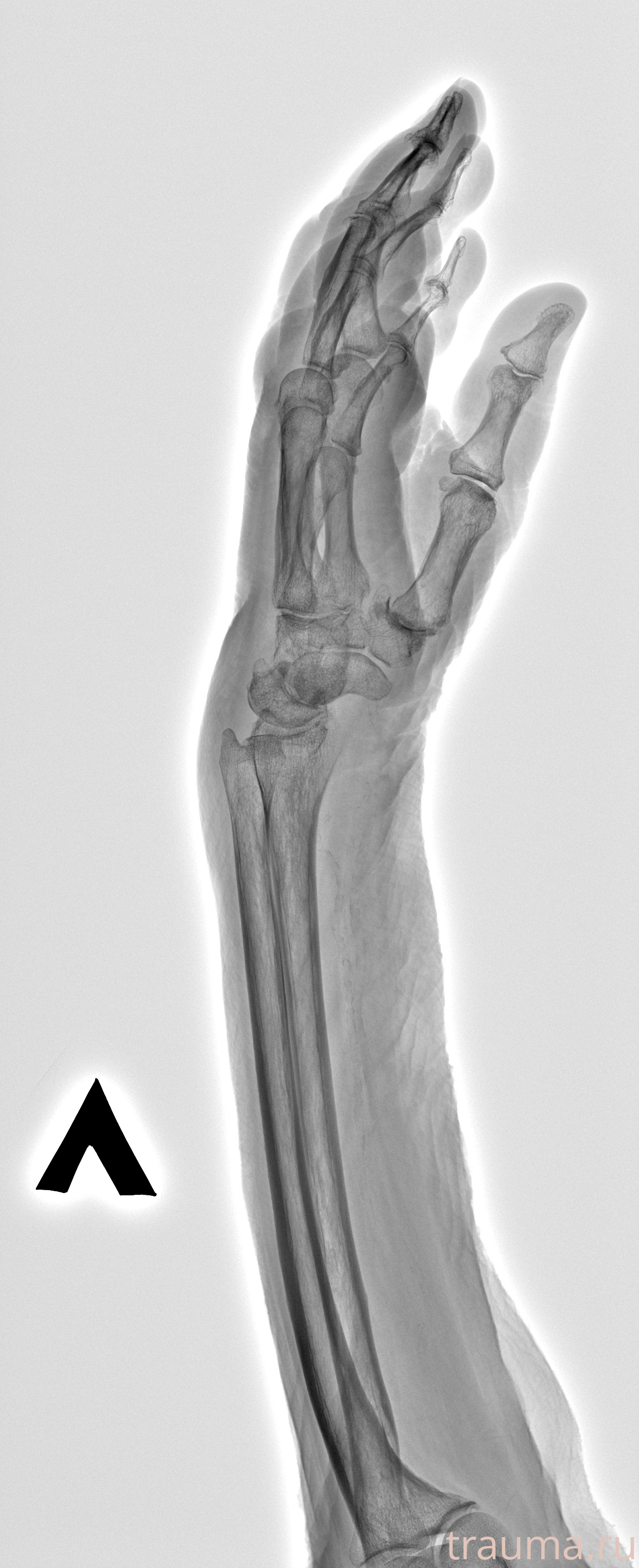 Рентген на дому: по вашему адресу приезжает врач-рентгенолог, травматолог-ортопед с мобильным рентгеновским аппаратом, проводит диагностику травмы или заболевания, делает необходимые рентгенограммы, дает рекомендации по дальнейшему лечению. Получить качественные снимки в домашних условиях возможно благодаря уникальной методике, разработанной МосРентген Центром для института  Склифосовского