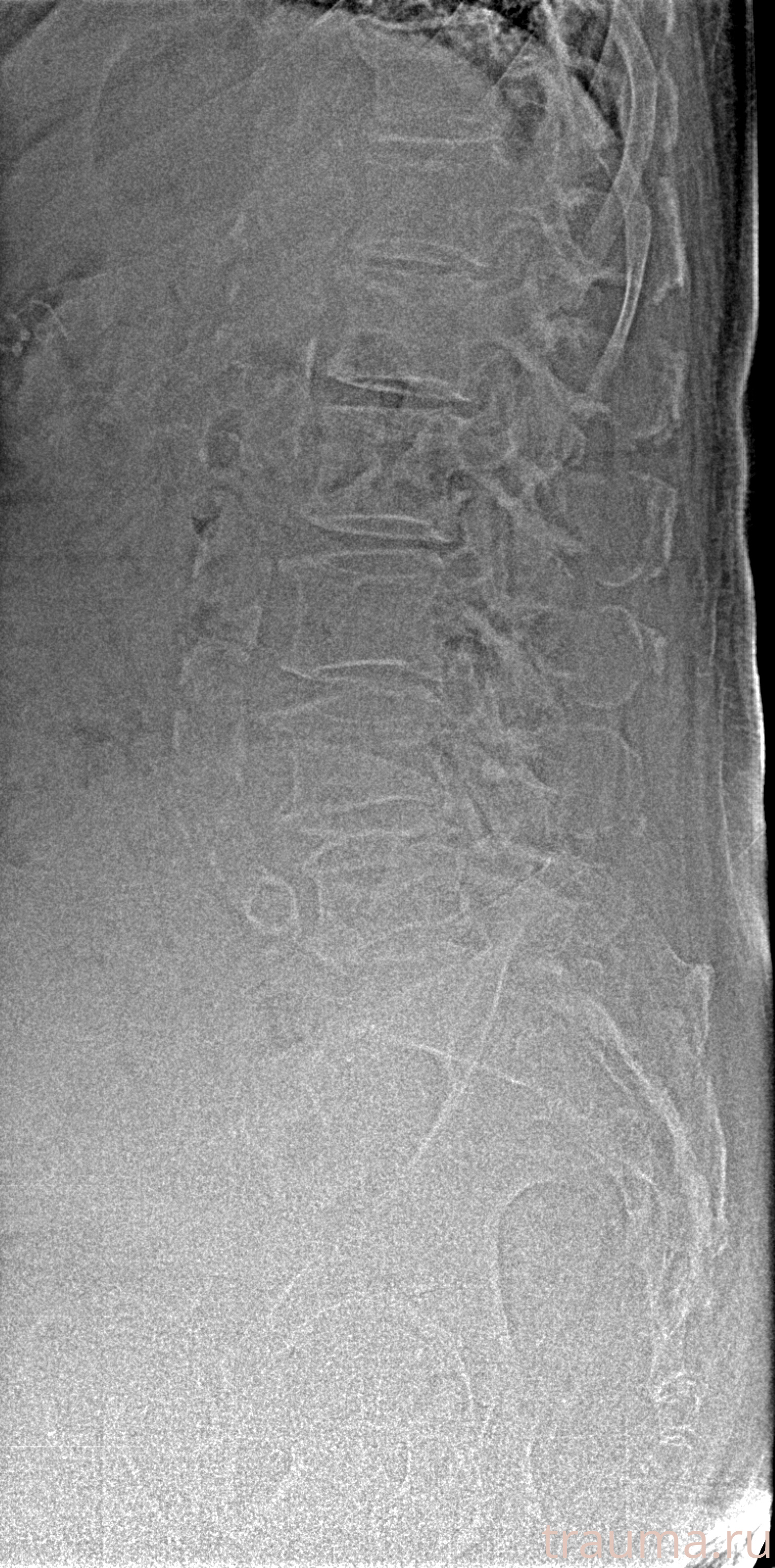 Рентген на дому: по вашему адресу приезжает врач-рентгенолог, травматолог-ортопед с мобильным рентгеновским аппаратом, проводит диагностику травмы или заболевания, делает необходимые рентгенограммы, дает рекомендации по дальнейшему лечению. Получить качественные снимки в домашних условиях возможно благодаря уникальной методике, разработанной МосРентген Центром для института  Склифосовского