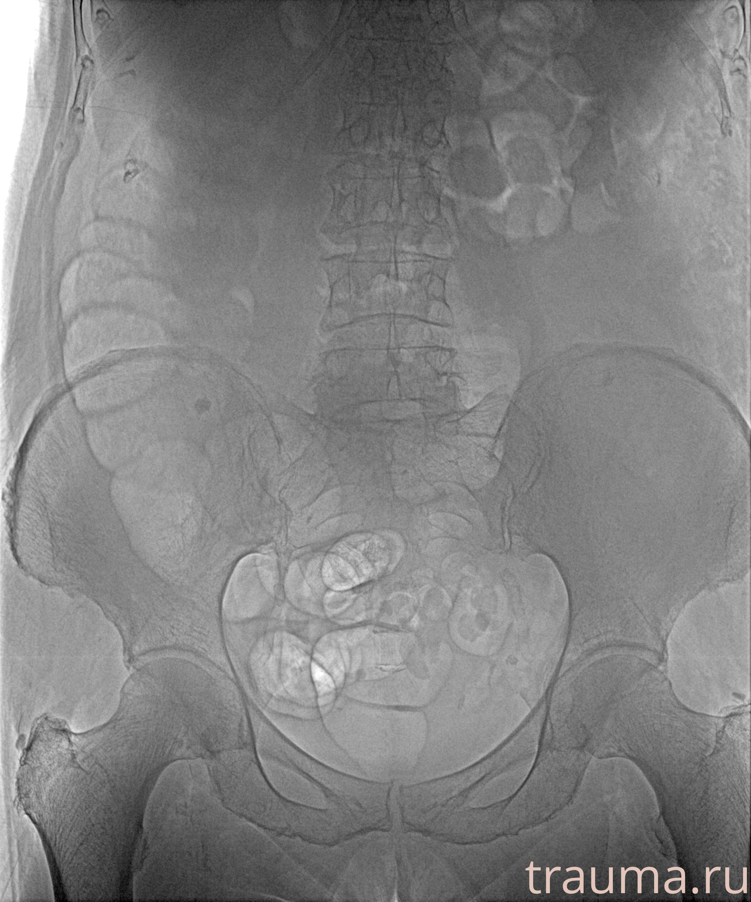 Рентген на дому: по вашему адресу приезжает врач-рентгенолог, травматолог-ортопед с мобильным рентгеновским аппаратом, проводит диагностику травмы или заболевания, делает необходимые рентгенограммы, дает рекомендации по дальнейшему лечению. Получить качественные снимки в домашних условиях возможно благодаря уникальной методике, разработанной МосРентген Центром для института  Склифосовского