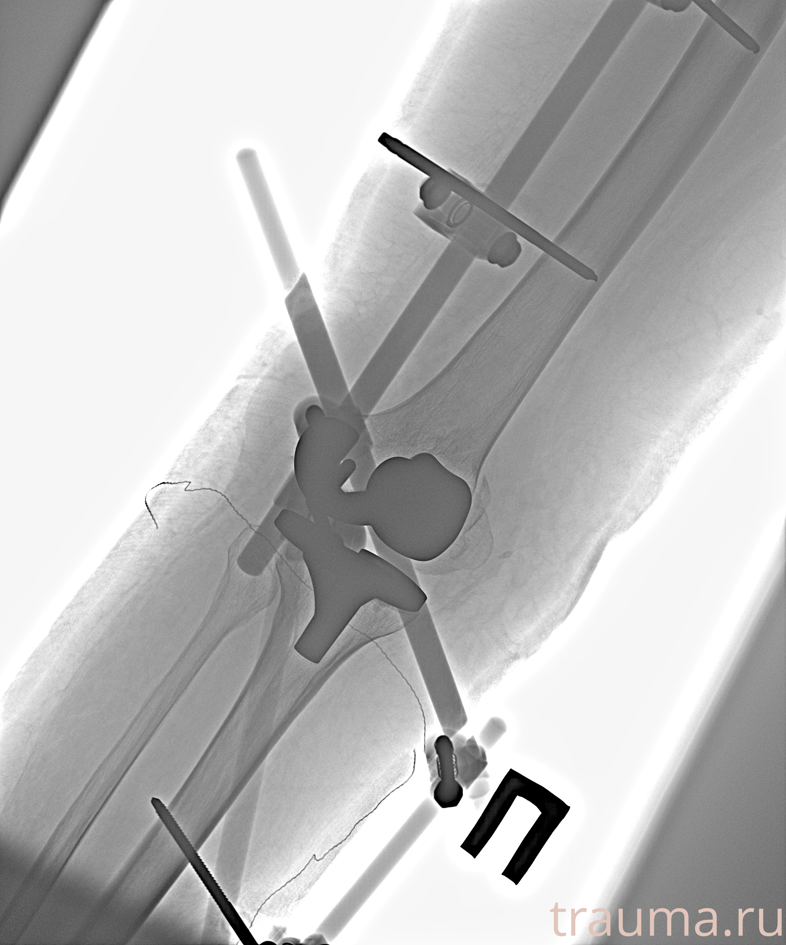 Рентген на дому: по вашему адресу приезжает врач-рентгенолог, травматолог-ортопед с мобильным рентгеновским аппаратом, проводит диагностику травмы или заболевания, делает необходимые рентгенограммы, дает рекомендации по дальнейшему лечению. Получить качественные снимки в домашних условиях возможно благодаря уникальной методике, разработанной МосРентген Центром для института  Склифосовского