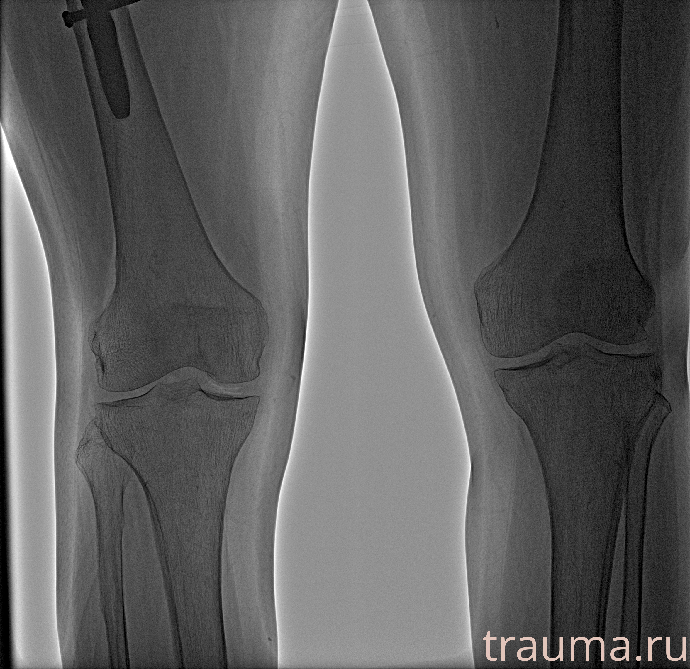 Рентген на дому: по вашему адресу приезжает врач-рентгенолог, травматолог-ортопед с мобильным рентгеновским аппаратом, проводит диагностику травмы или заболевания, делает необходимые рентгенограммы, дает рекомендации по дальнейшему лечению. Получить качественные снимки в домашних условиях возможно благодаря уникальной методике, разработанной МосРентген Центром для института  Склифосовского
