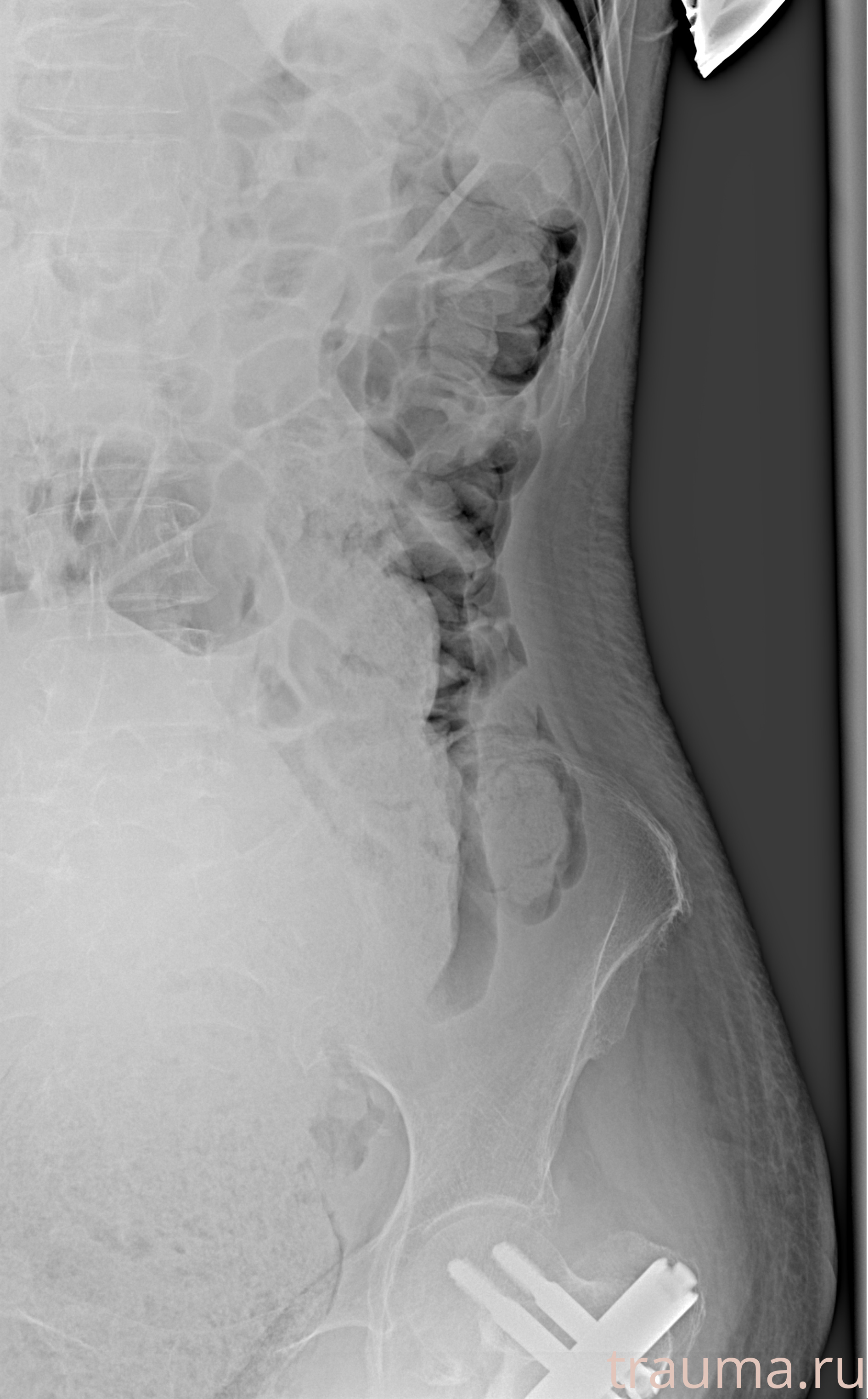 Рентген на дому: по вашему адресу приезжает врач-рентгенолог, травматолог-ортопед с мобильным рентгеновским аппаратом, проводит диагностику травмы или заболевания, делает необходимые рентгенограммы, дает рекомендации по дальнейшему лечению. Получить качественные снимки в домашних условиях возможно благодаря уникальной методике, разработанной МосРентген Центром для института  Склифосовского