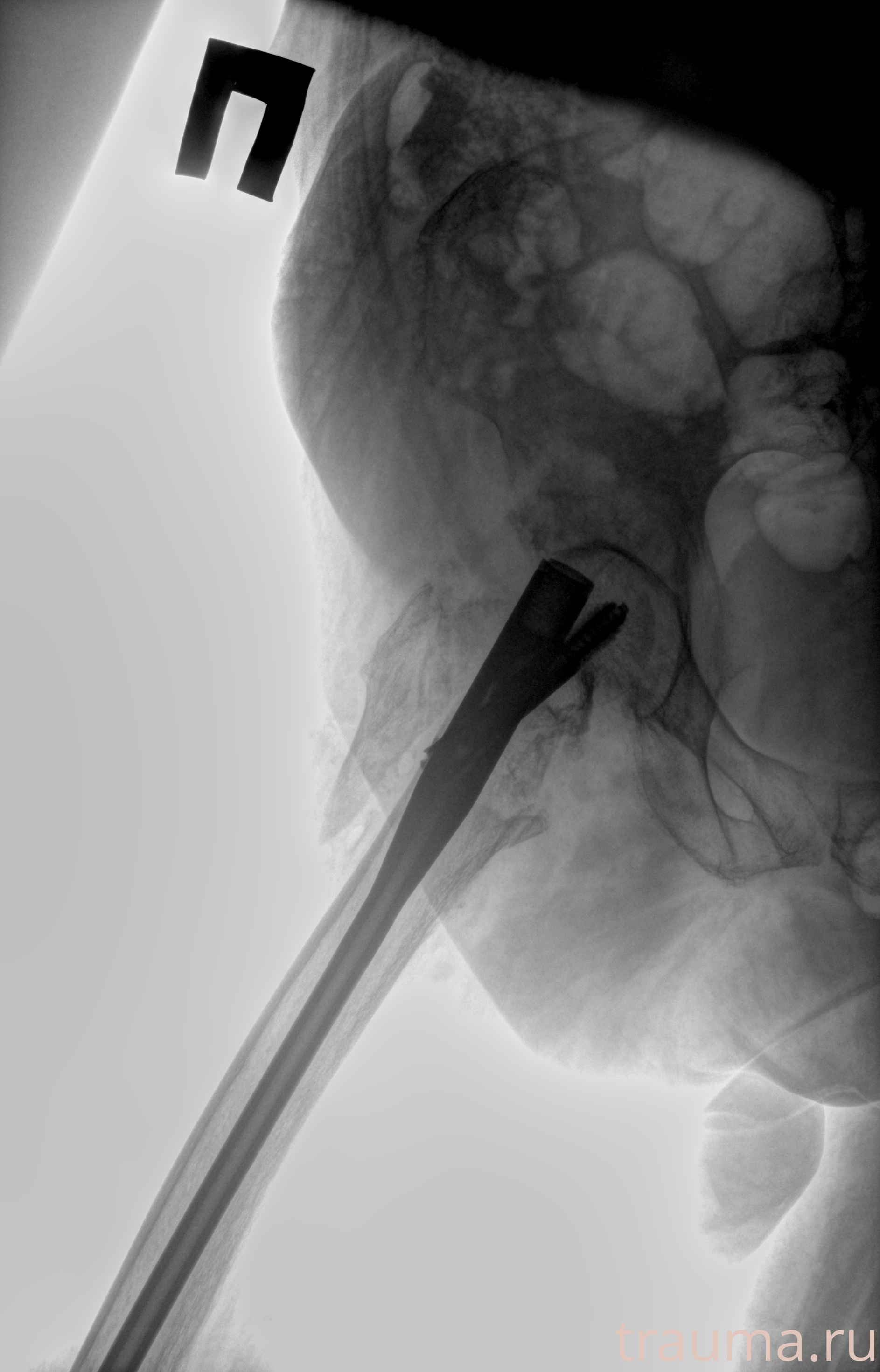 Рентген на дому: по вашему адресу приезжает врач-рентгенолог, травматолог-ортопед с мобильным рентгеновским аппаратом, проводит диагностику травмы или заболевания, делает необходимые рентгенограммы, дает рекомендации по дальнейшему лечению. Получить качественные снимки в домашних условиях возможно благодаря уникальной методике, разработанной МосРентген Центром для института  Склифосовского