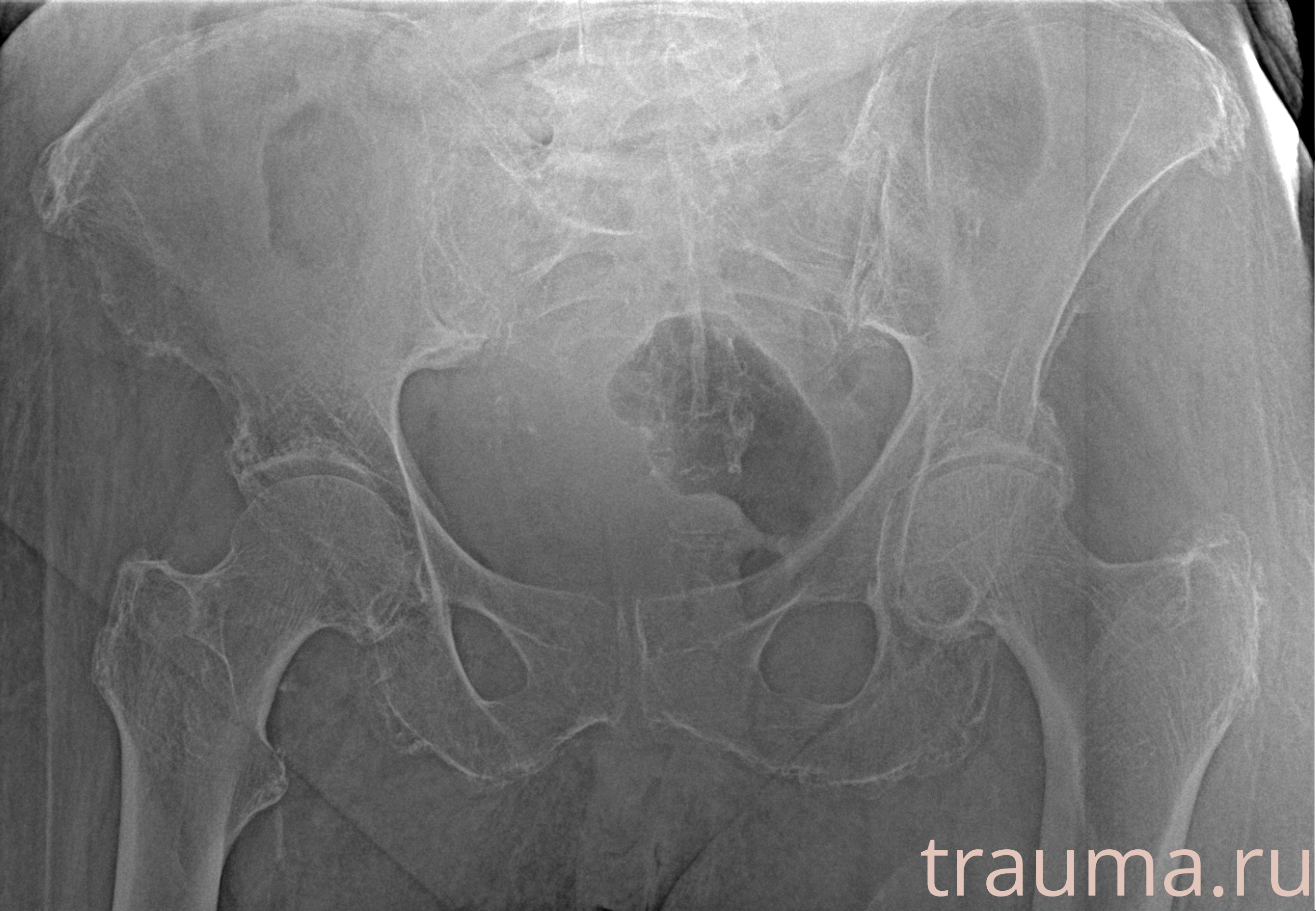 Рентген на дому: по вашему адресу приезжает врач-рентгенолог, травматолог-ортопед с мобильным рентгеновским аппаратом, проводит диагностику травмы или заболевания, делает необходимые рентгенограммы, дает рекомендации по дальнейшему лечению. Получить качественные снимки в домашних условиях возможно благодаря уникальной методике, разработанной МосРентген Центром для института  Склифосовского