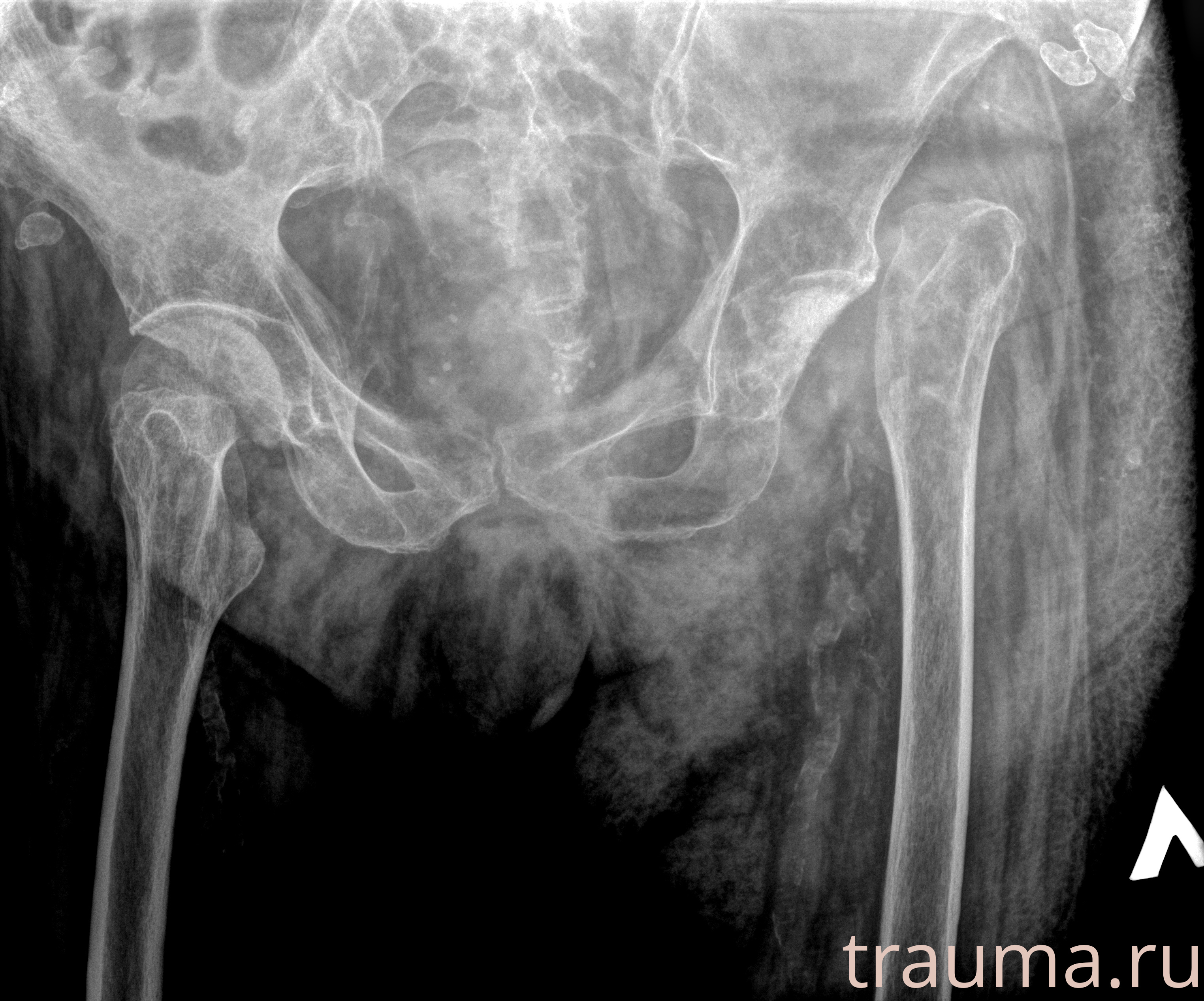 Рентген на дому: по вашему адресу приезжает врач-рентгенолог, травматолог-ортопед с мобильным рентгеновским аппаратом, проводит диагностику травмы или заболевания, делает необходимые рентгенограммы, дает рекомендации по дальнейшему лечению. Получить качественные снимки в домашних условиях возможно благодаря уникальной методике, разработанной МосРентген Центром для института  Склифосовского