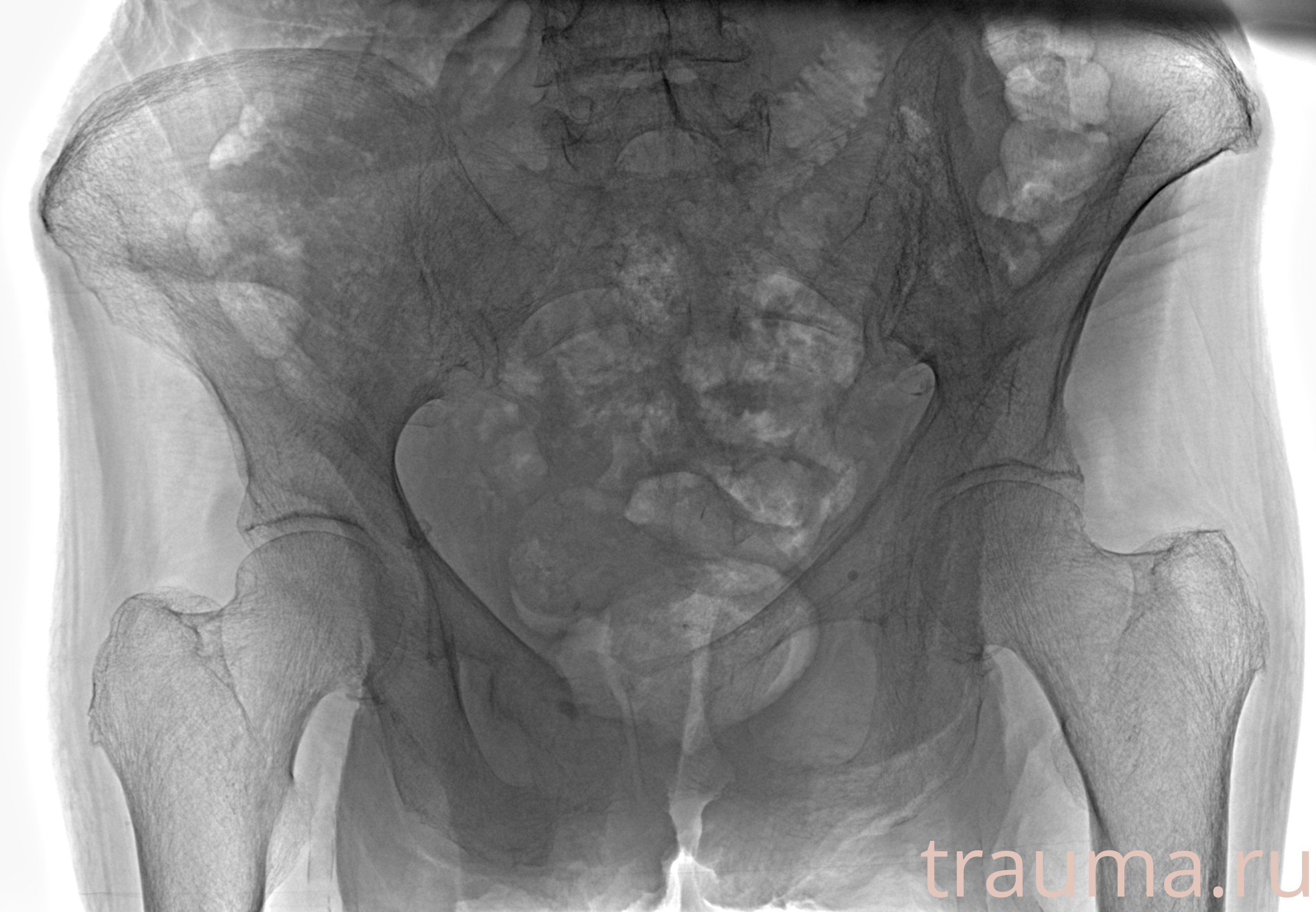 Рентген на дому: по вашему адресу приезжает врач-рентгенолог, травматолог-ортопед с мобильным рентгеновским аппаратом, проводит диагностику травмы или заболевания, делает необходимые рентгенограммы, дает рекомендации по дальнейшему лечению. Получить качественные снимки в домашних условиях возможно благодаря уникальной методике, разработанной МосРентген Центром для института  Склифосовского