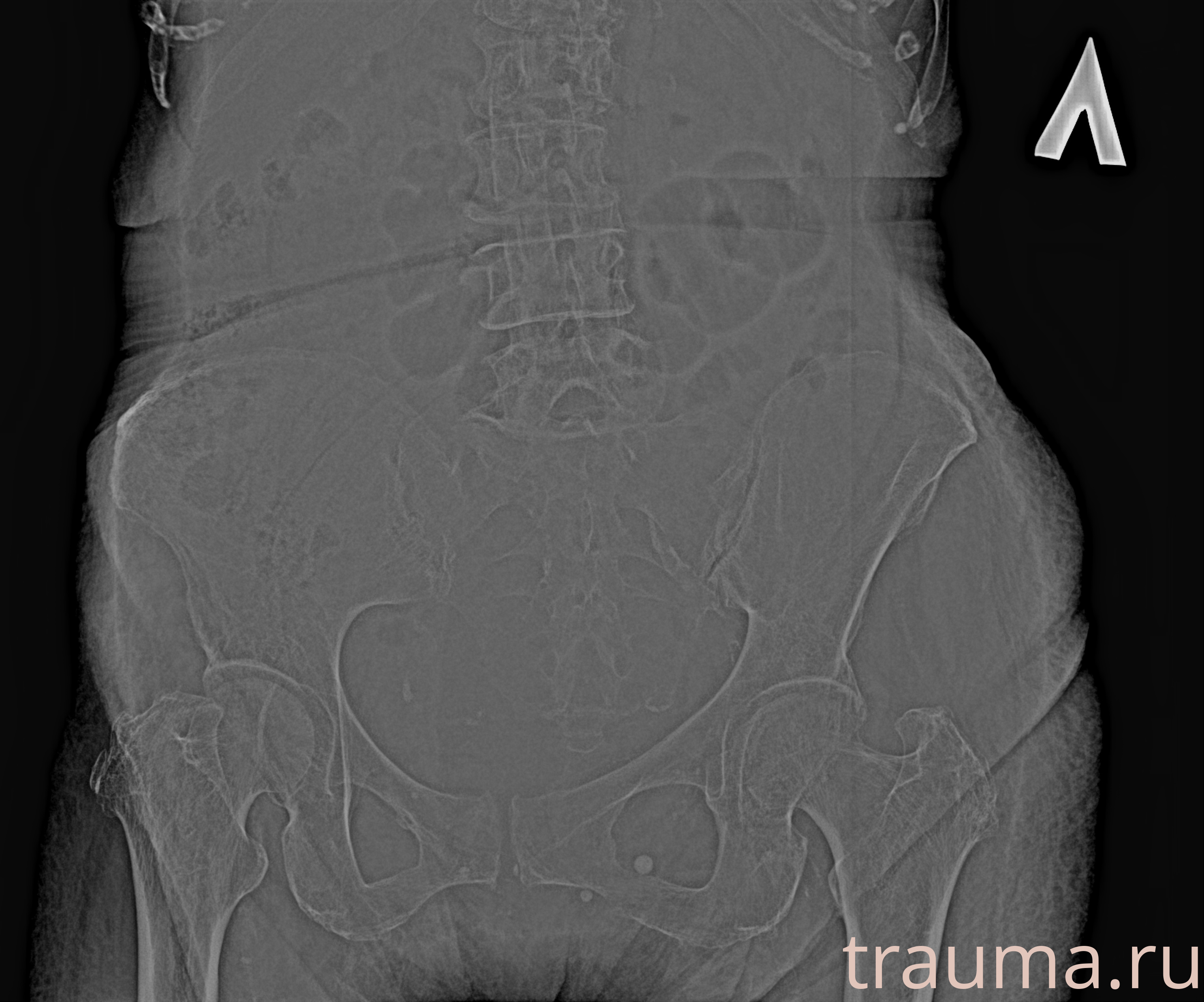 Рентген на дому: по вашему адресу приезжает врач-рентгенолог, травматолог-ортопед с мобильным рентгеновским аппаратом, проводит диагностику травмы или заболевания, делает необходимые рентгенограммы, дает рекомендации по дальнейшему лечению. Получить качественные снимки в домашних условиях возможно благодаря уникальной методике, разработанной МосРентген Центром для института  Склифосовского