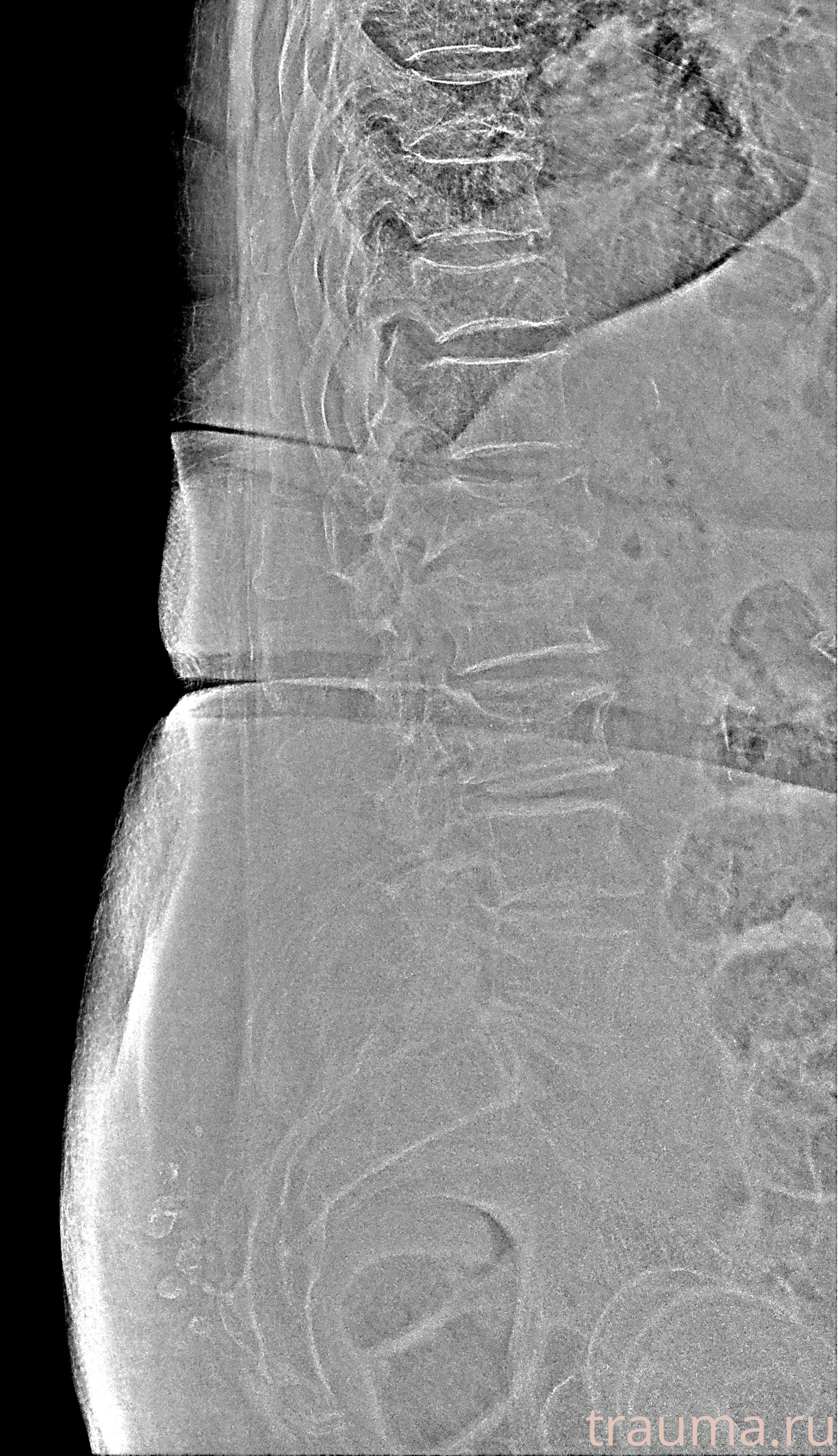 Рентген на дому: по вашему адресу приезжает врач-рентгенолог, травматолог-ортопед с мобильным рентгеновским аппаратом, проводит диагностику травмы или заболевания, делает необходимые рентгенограммы, дает рекомендации по дальнейшему лечению. Получить качественные снимки в домашних условиях возможно благодаря уникальной методике, разработанной МосРентген Центром для института  Склифосовского