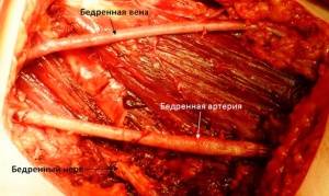 Первичный шов при повреждении бедренной артерии Первичный шов при повреждении бедренной артерии
