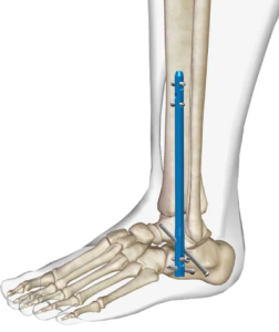 Влияние нарушений костного метаболизма на частоту несращений при ревизионных операциях на стопе
