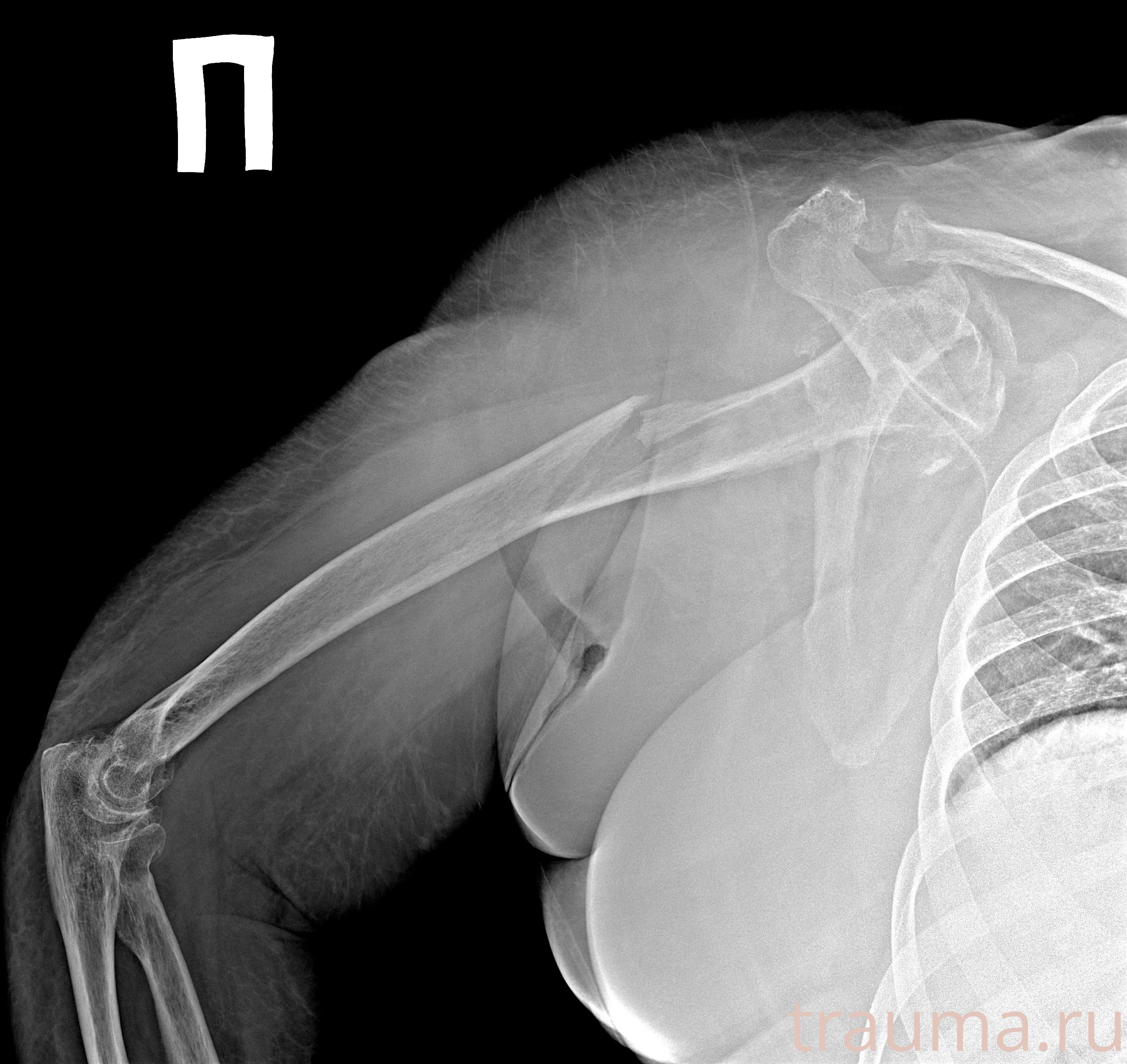 Рентген на дому: по вашему адресу приезжает врач-рентгенолог, травматолог-ортопед с мобильным рентгеновским аппаратом, проводит диагностику травмы или заболевания, делает необходимые рентгенограммы, дает рекомендации по дальнейшему лечению. Получить качественные снимки в домашних условиях возможно благодаря уникальной методике, разработанной МосРентген Центром для института  Склифосовского