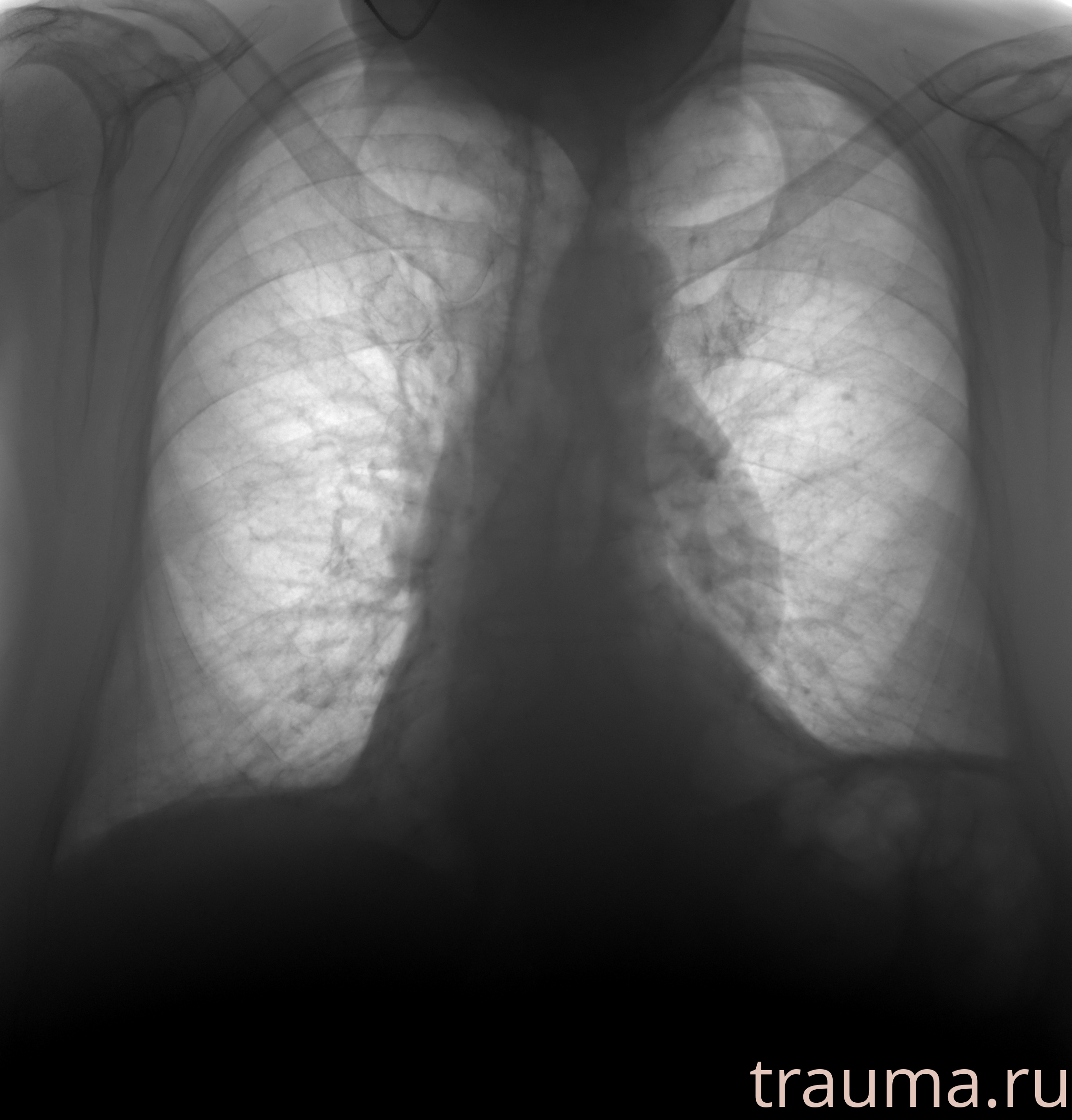 Рентген на дому: по вашему адресу приезжает врач-рентгенолог, травматолог-ортопед с мобильным рентгеновским аппаратом, проводит диагностику травмы или заболевания, делает необходимые рентгенограммы, дает рекомендации по дальнейшему лечению. Получить качественные снимки в домашних условиях возможно благодаря уникальной методике, разработанной МосРентген Центром для института  Склифосовского