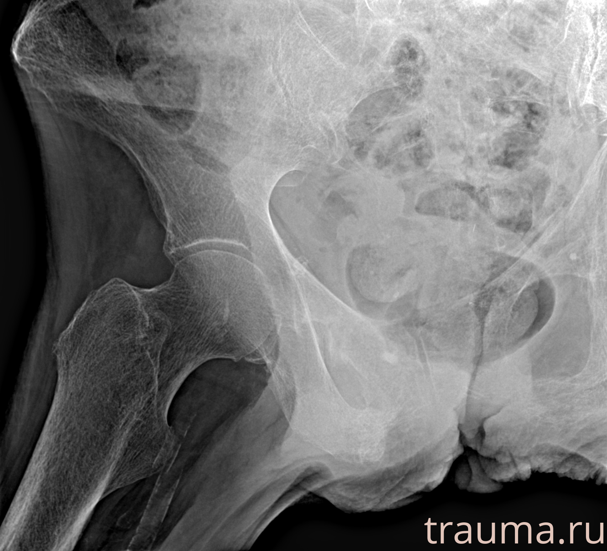 Рентген на дому: по вашему адресу приезжает врач-рентгенолог, травматолог-ортопед с мобильным рентгеновским аппаратом, проводит диагностику травмы или заболевания, делает необходимые рентгенограммы, дает рекомендации по дальнейшему лечению. Получить качественные снимки в домашних условиях возможно благодаря уникальной методике, разработанной МосРентген Центром для института  Склифосовского