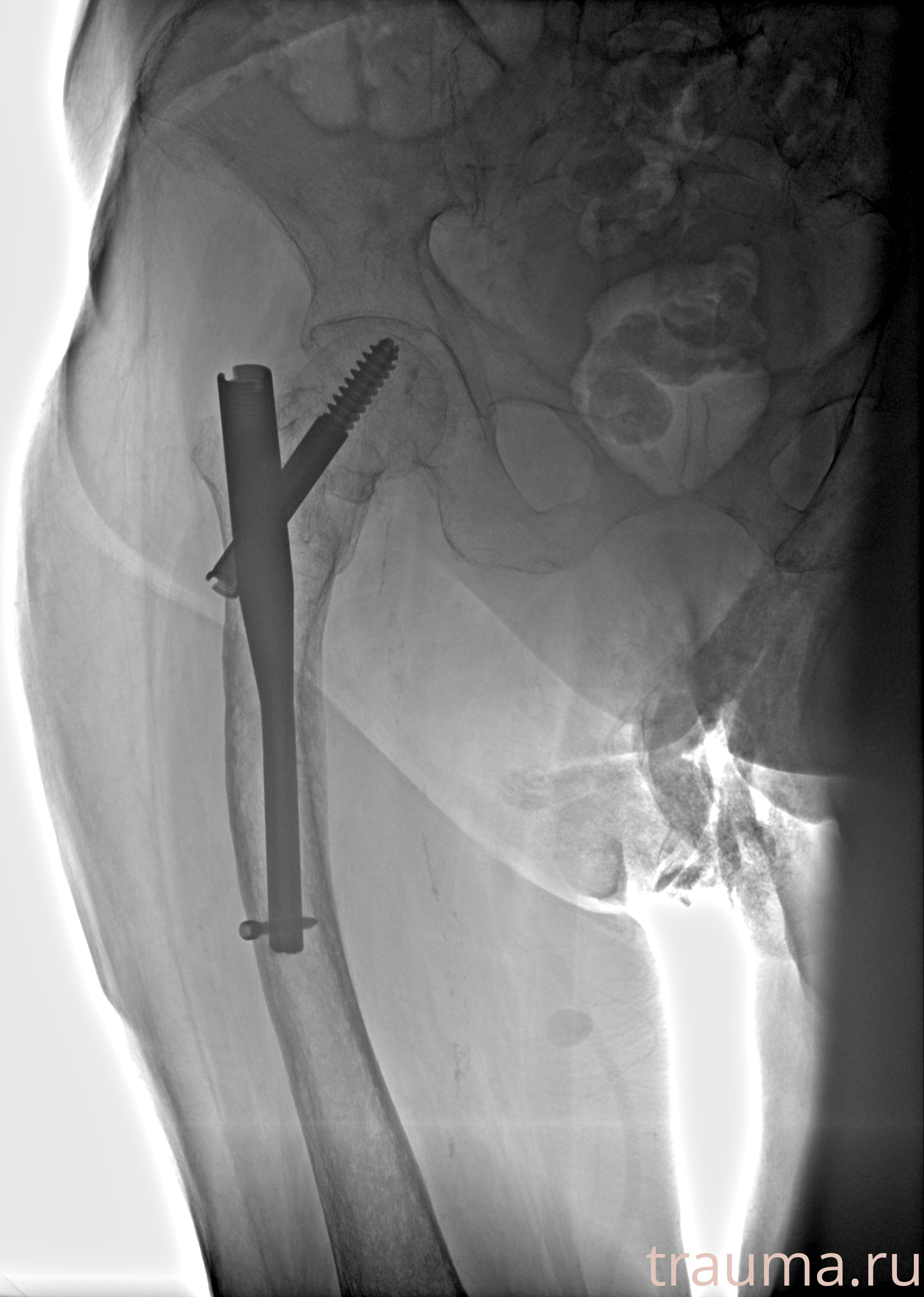 Рентген на дому: по вашему адресу приезжает врач-рентгенолог, травматолог-ортопед с мобильным рентгеновским аппаратом, проводит диагностику травмы или заболевания, делает необходимые рентгенограммы, дает рекомендации по дальнейшему лечению. Получить качественные снимки в домашних условиях возможно благодаря уникальной методике, разработанной МосРентген Центром для института  Склифосовского