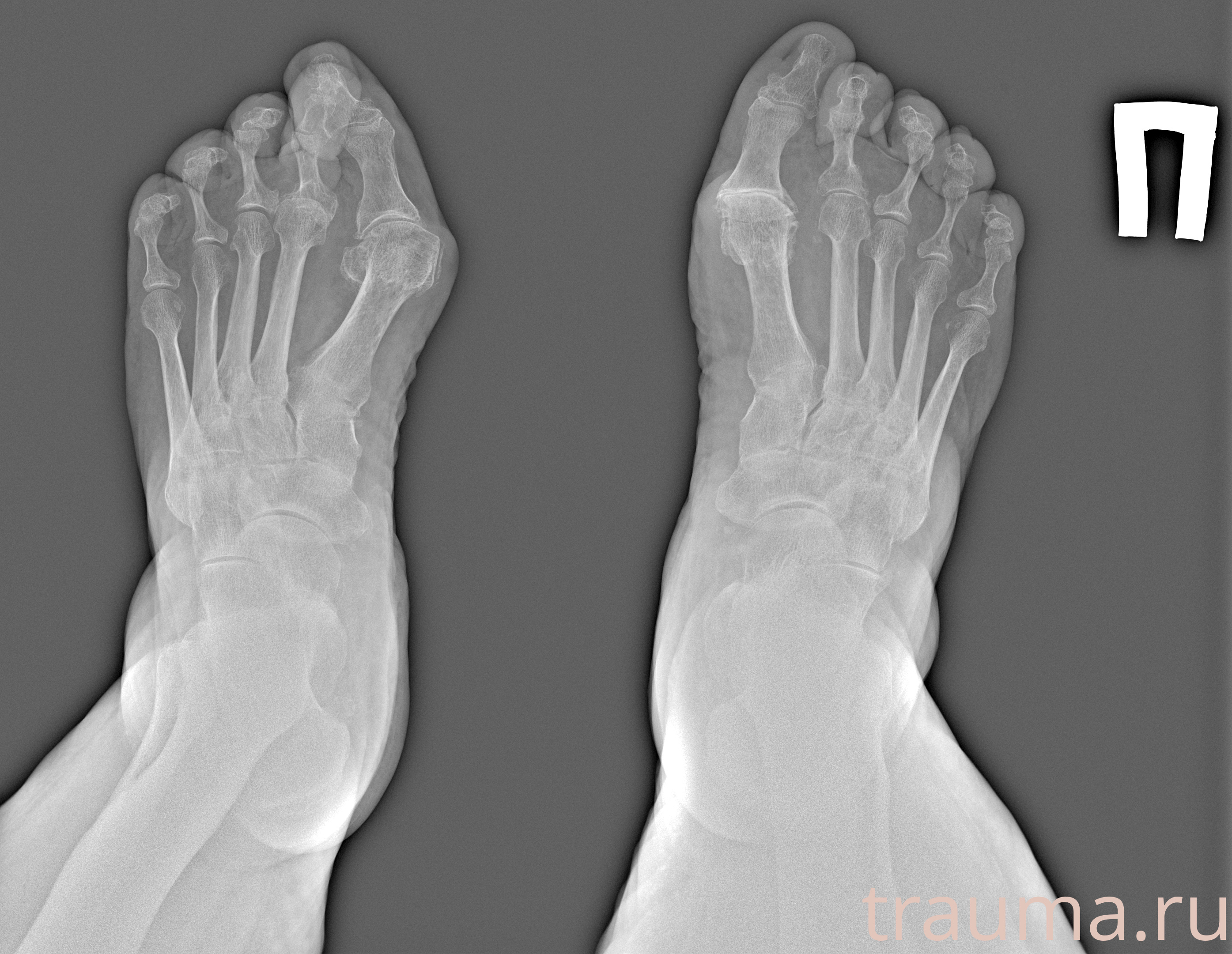 Рентген на дому: по вашему адресу приезжает врач-рентгенолог, травматолог-ортопед с мобильным рентгеновским аппаратом, проводит диагностику травмы или заболевания, делает необходимые рентгенограммы, дает рекомендации по дальнейшему лечению. Получить качественные снимки в домашних условиях возможно благодаря уникальной методике, разработанной МосРентген Центром для института  Склифосовского