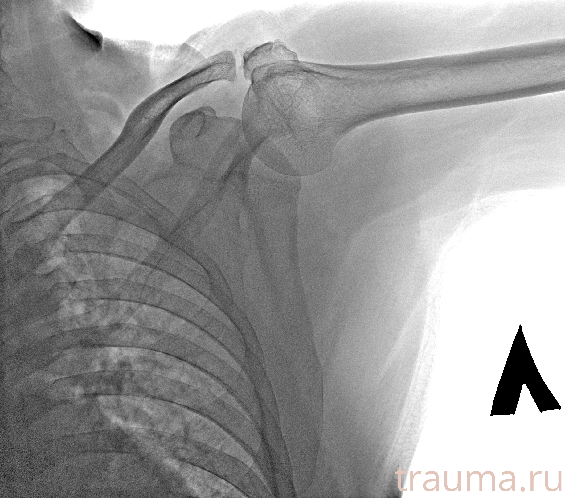 Рентген на дому: по вашему адресу приезжает врач-рентгенолог, травматолог-ортопед с мобильным рентгеновским аппаратом, проводит диагностику травмы или заболевания, делает необходимые рентгенограммы, дает рекомендации по дальнейшему лечению. Получить качественные снимки в домашних условиях возможно благодаря уникальной методике, разработанной МосРентген Центром для института  Склифосовского