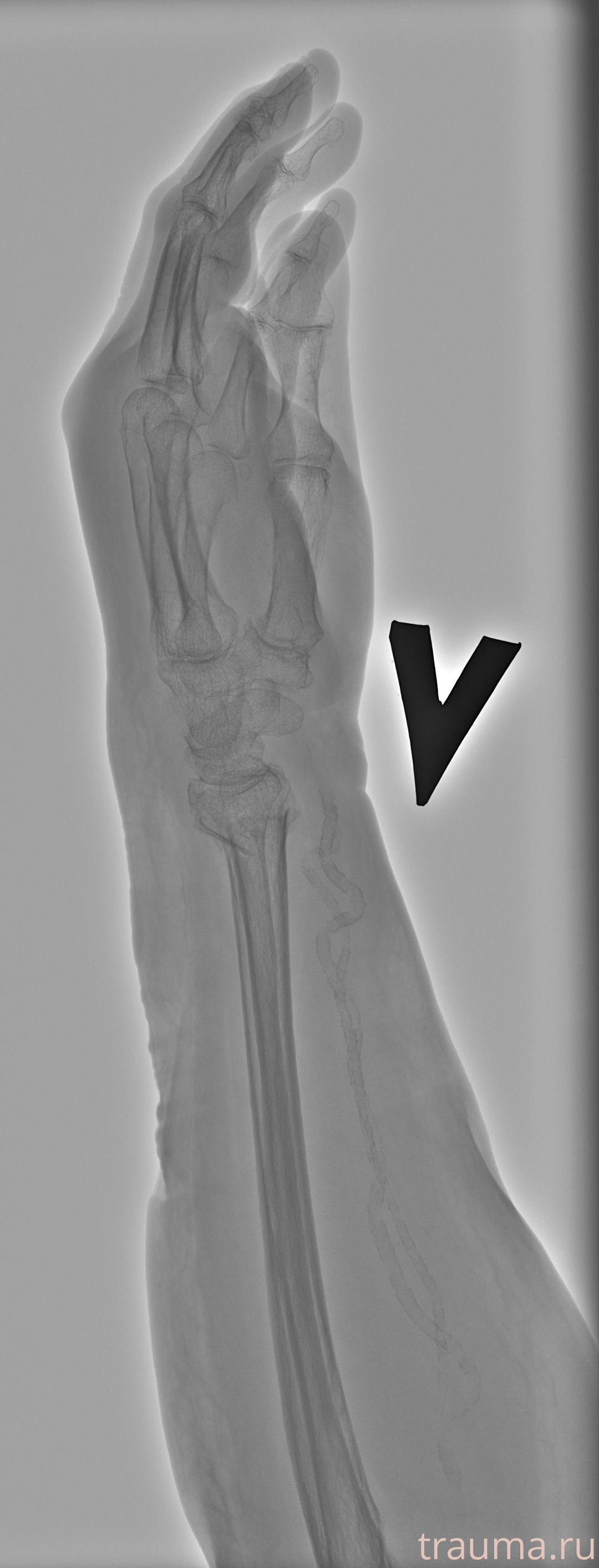 Рентген на дому: по вашему адресу приезжает врач-рентгенолог, травматолог-ортопед с мобильным рентгеновским аппаратом, проводит диагностику травмы или заболевания, делает необходимые рентгенограммы, дает рекомендации по дальнейшему лечению. Получить качественные снимки в домашних условиях возможно благодаря уникальной методике, разработанной МосРентген Центром для института  Склифосовского