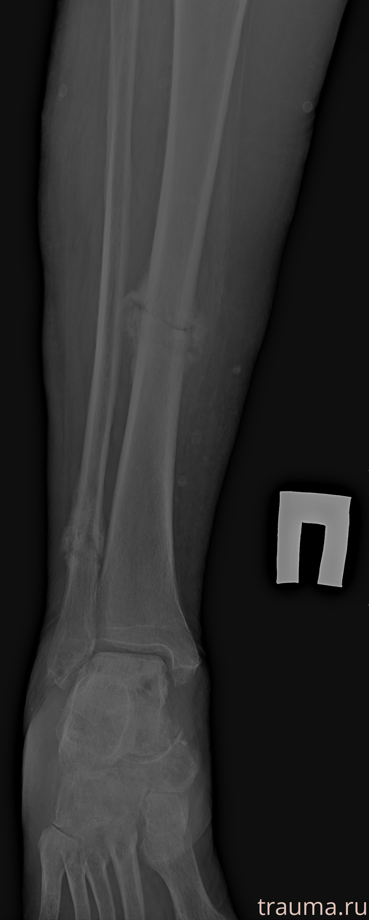 Рентген на дому: по вашему адресу приезжает врач-рентгенолог, травматолог-ортопед с мобильным рентгеновским аппаратом, проводит диагностику травмы или заболевания, делает необходимые рентгенограммы, дает рекомендации по дальнейшему лечению. Получить качественные снимки в домашних условиях возможно благодаря уникальной методике, разработанной МосРентген Центром для института  Склифосовского