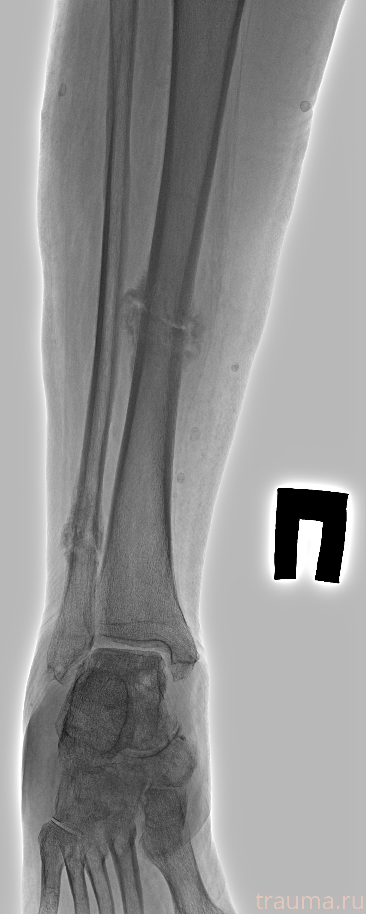 Рентген на дому: по вашему адресу приезжает врач-рентгенолог, травматолог-ортопед с мобильным рентгеновским аппаратом, проводит диагностику травмы или заболевания, делает необходимые рентгенограммы, дает рекомендации по дальнейшему лечению. Получить качественные снимки в домашних условиях возможно благодаря уникальной методике, разработанной МосРентген Центром для института  Склифосовского