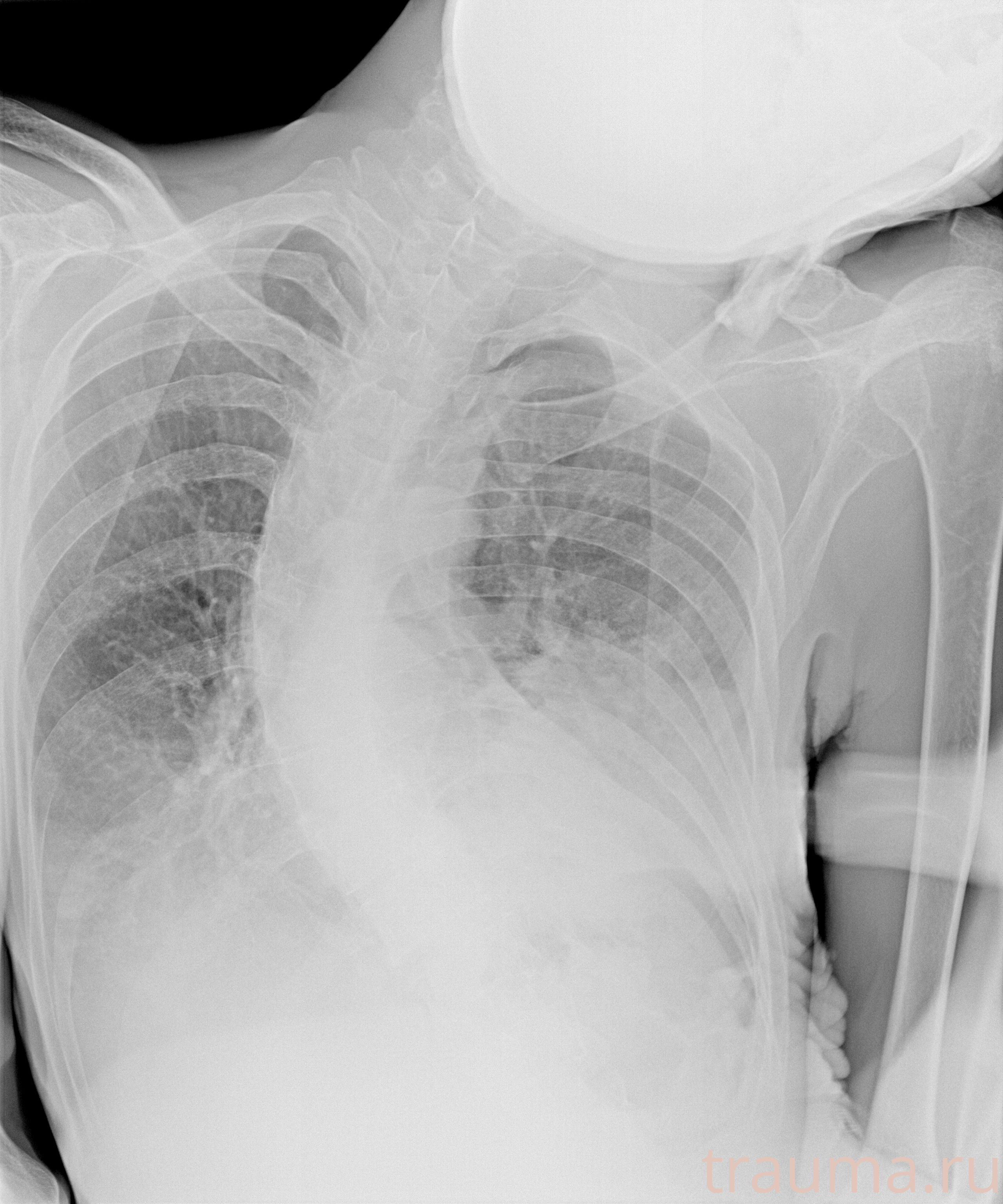 Рентген на дому: по вашему адресу приезжает врач-рентгенолог, травматолог-ортопед с мобильным рентгеновским аппаратом, проводит диагностику травмы или заболевания, делает необходимые рентгенограммы, дает рекомендации по дальнейшему лечению. Получить качественные снимки в домашних условиях возможно благодаря уникальной методике, разработанной МосРентген Центром для института  Склифосовского