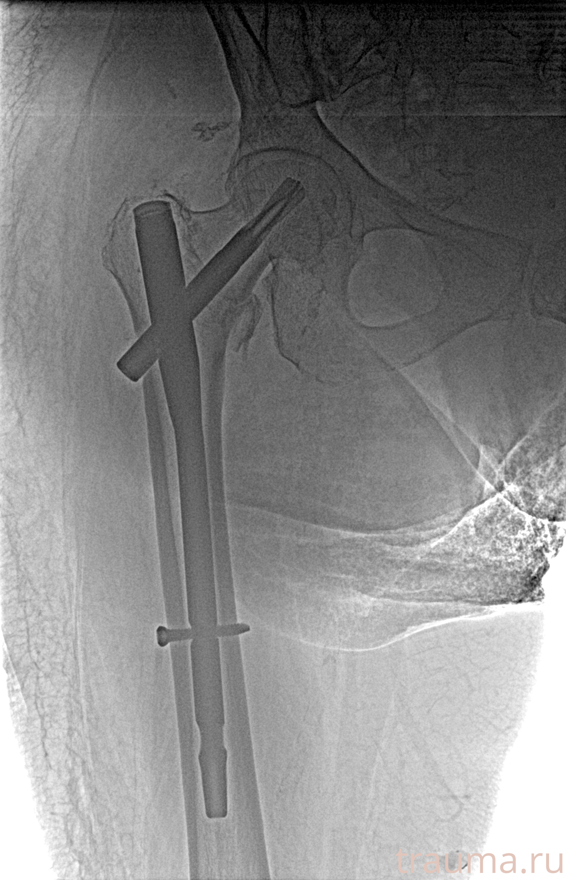 Рентген на дому: по вашему адресу приезжает врач-рентгенолог, травматолог-ортопед с мобильным рентгеновским аппаратом, проводит диагностику травмы или заболевания, делает необходимые рентгенограммы, дает рекомендации по дальнейшему лечению. Получить качественные снимки в домашних условиях возможно благодаря уникальной методике, разработанной МосРентген Центром для института  Склифосовского
