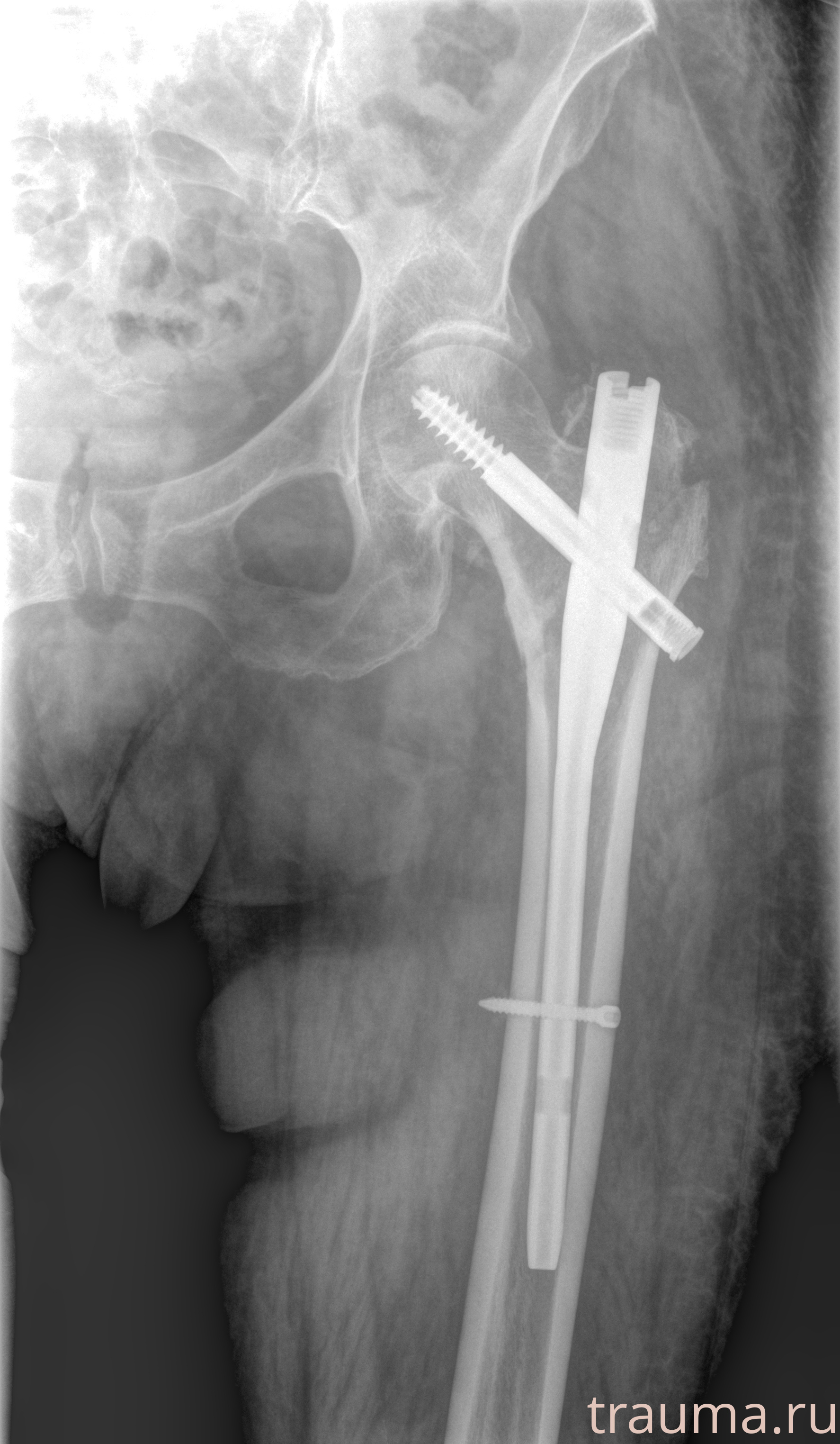 Рентген на дому: по вашему адресу приезжает врач-рентгенолог, травматолог-ортопед с мобильным рентгеновским аппаратом, проводит диагностику травмы или заболевания, делает необходимые рентгенограммы, дает рекомендации по дальнейшему лечению. Получить качественные снимки в домашних условиях возможно благодаря уникальной методике, разработанной МосРентген Центром для института  Склифосовского