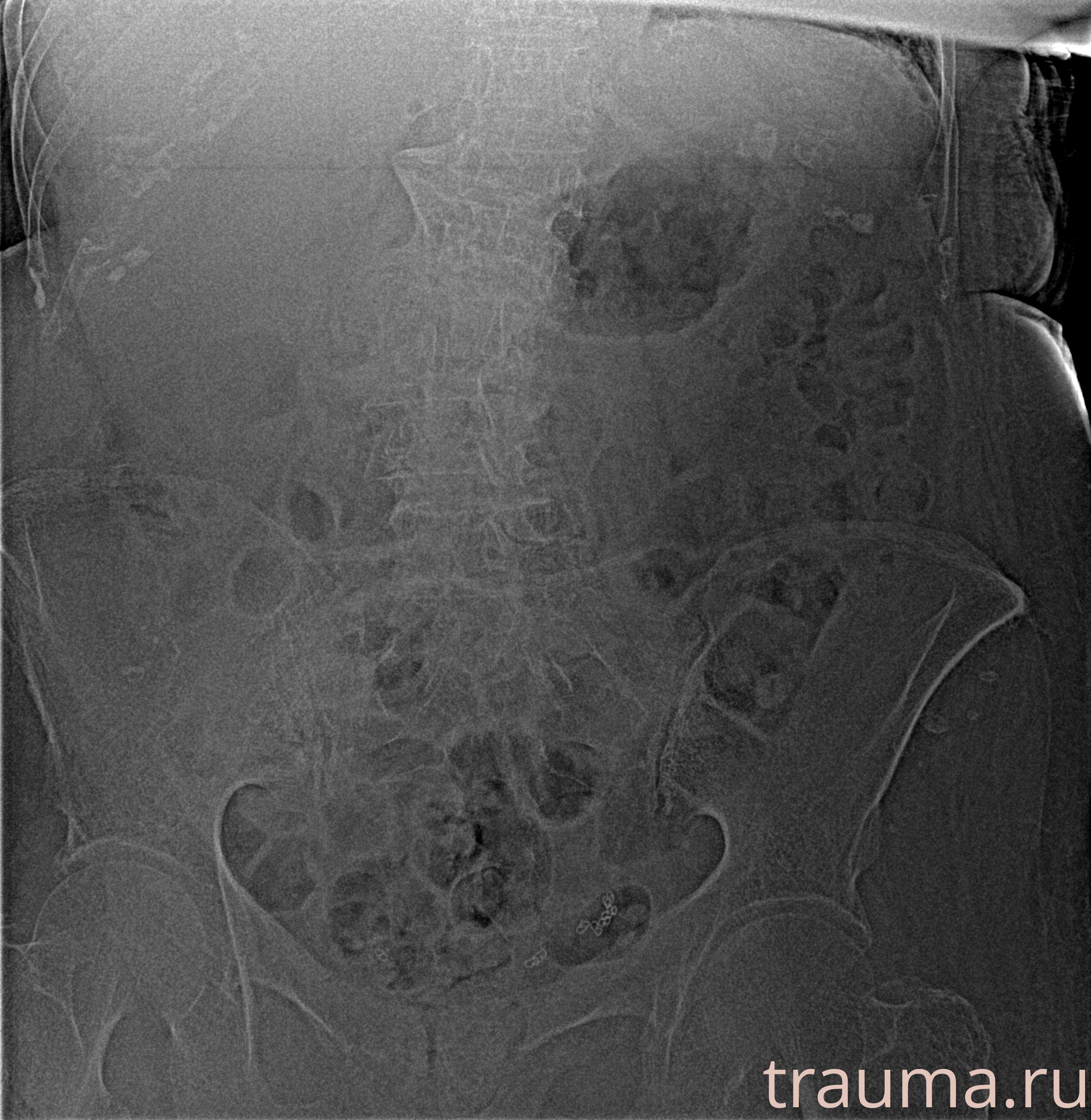 Рентген на дому: по вашему адресу приезжает врач-рентгенолог, травматолог-ортопед с мобильным рентгеновским аппаратом, проводит диагностику травмы или заболевания, делает необходимые рентгенограммы, дает рекомендации по дальнейшему лечению. Получить качественные снимки в домашних условиях возможно благодаря уникальной методике, разработанной МосРентген Центром для института  Склифосовского