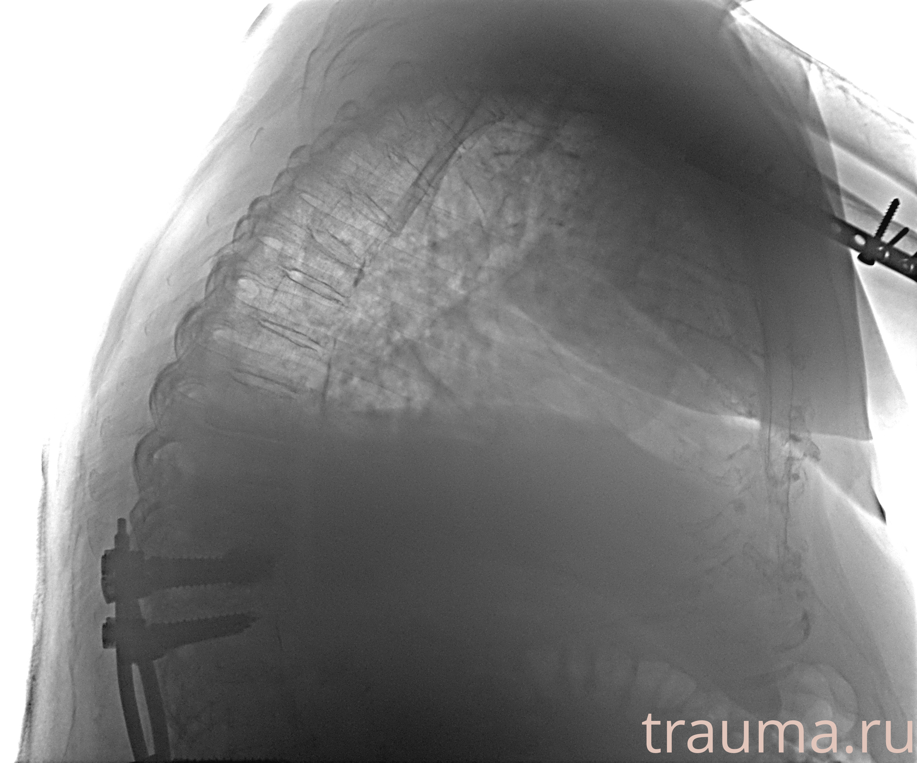 Рентген на дому: по вашему адресу приезжает врач-рентгенолог, травматолог-ортопед с мобильным рентгеновским аппаратом, проводит диагностику травмы или заболевания, делает необходимые рентгенограммы, дает рекомендации по дальнейшему лечению. Получить качественные снимки в домашних условиях возможно благодаря уникальной методике, разработанной МосРентген Центром для института  Склифосовского