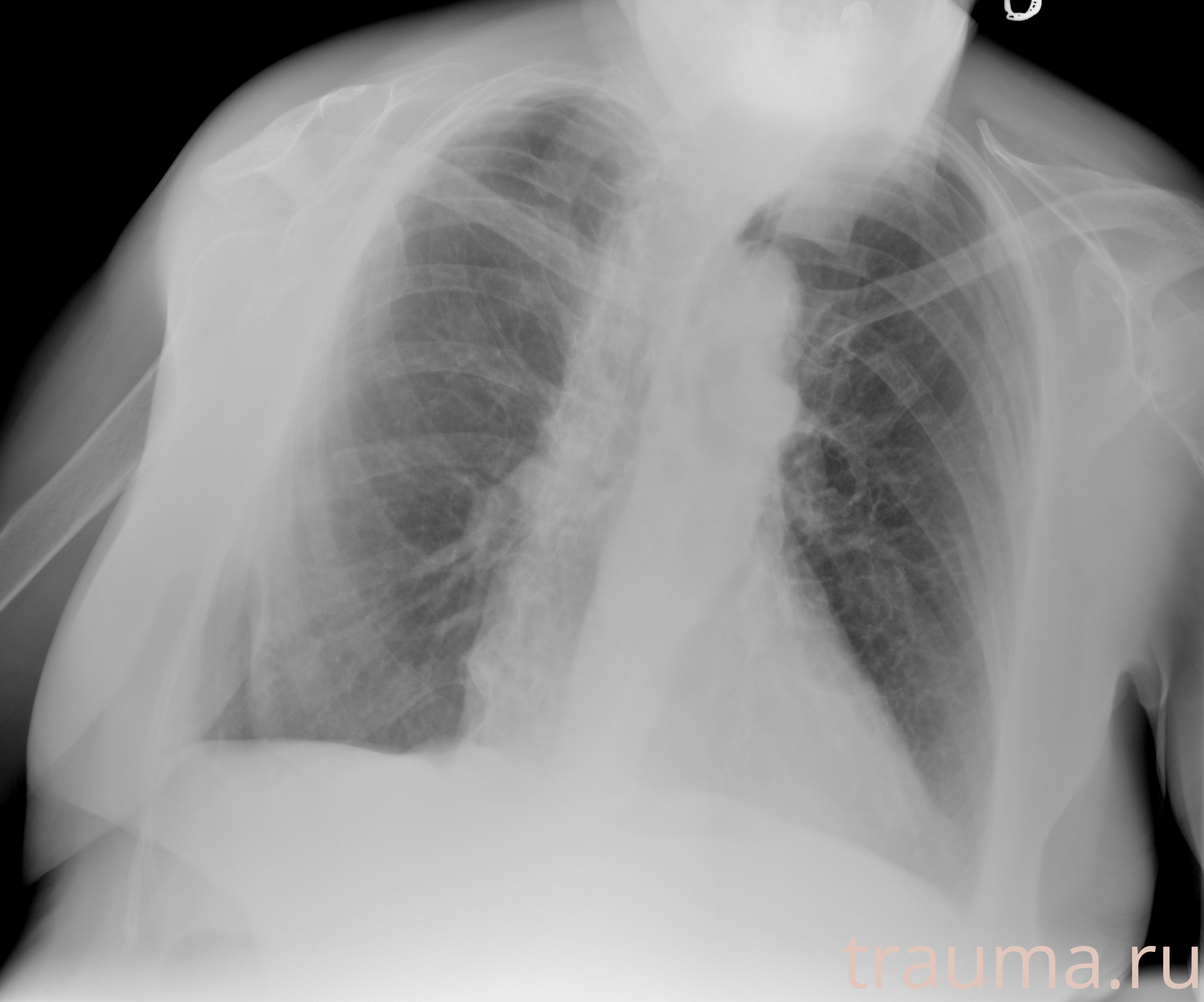 Рентген на дому: по вашему адресу приезжает врач-рентгенолог, травматолог-ортопед с мобильным рентгеновским аппаратом, проводит диагностику травмы или заболевания, делает необходимые рентгенограммы, дает рекомендации по дальнейшему лечению. Получить качественные снимки в домашних условиях возможно благодаря уникальной методике, разработанной МосРентген Центром для института  Склифосовского