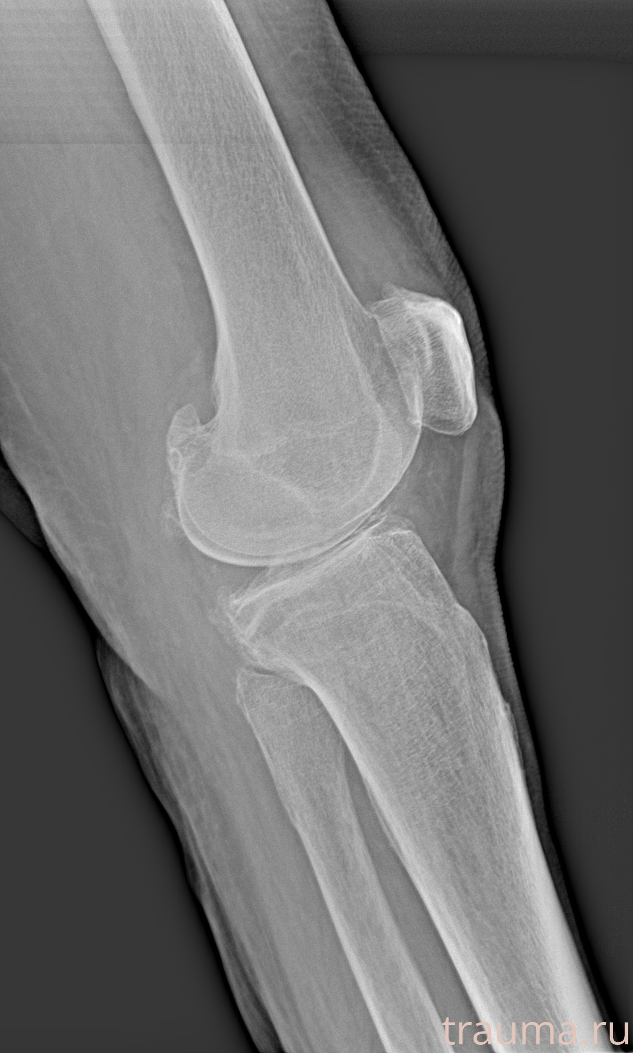 Рентген на дому: по вашему адресу приезжает врач-рентгенолог, травматолог-ортопед с мобильным рентгеновским аппаратом, проводит диагностику травмы или заболевания, делает необходимые рентгенограммы, дает рекомендации по дальнейшему лечению. Получить качественные снимки в домашних условиях возможно благодаря уникальной методике, разработанной МосРентген Центром для института  Склифосовского