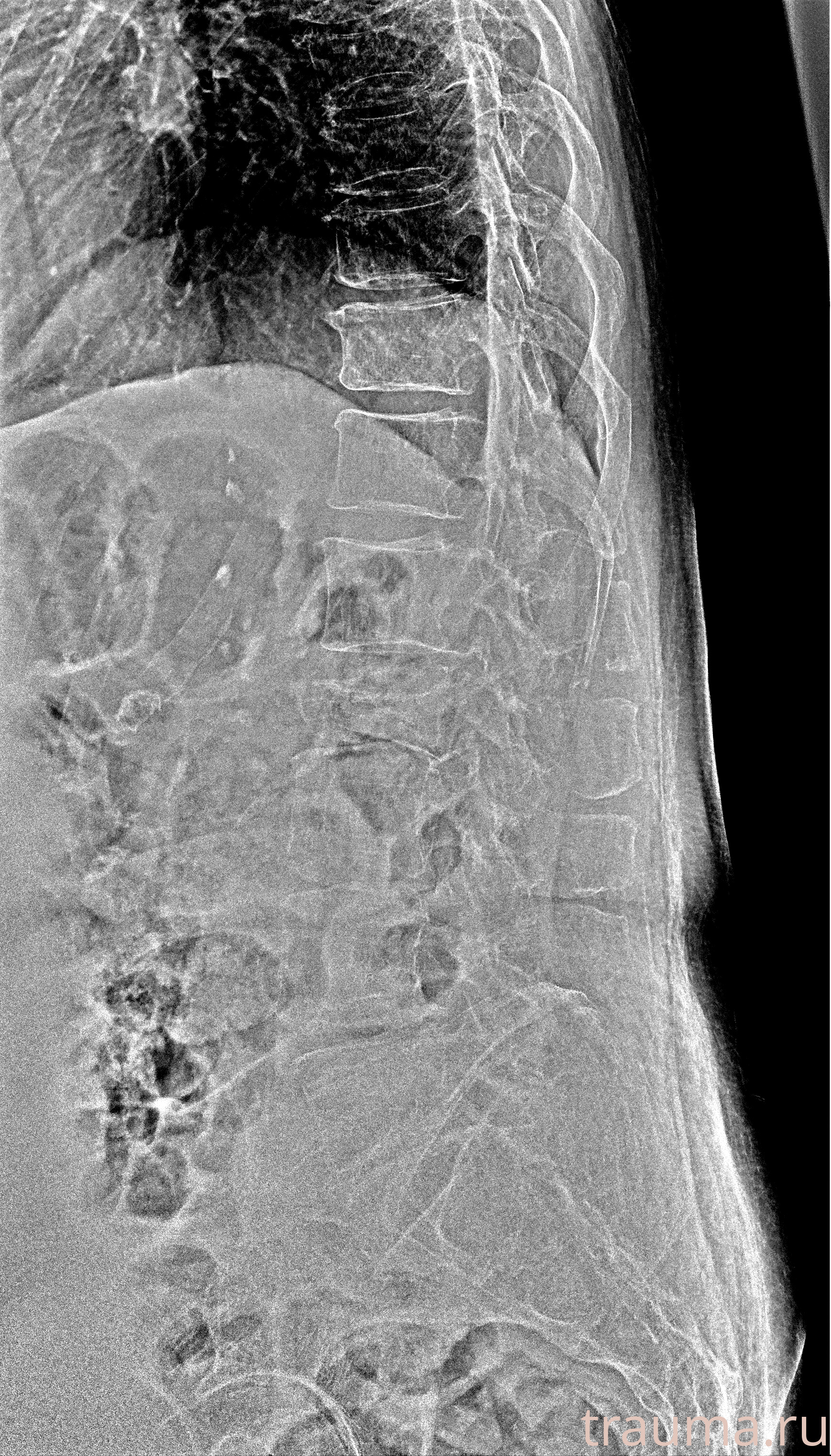 Рентген на дому: по вашему адресу приезжает врач-рентгенолог, травматолог-ортопед с мобильным рентгеновским аппаратом, проводит диагностику травмы или заболевания, делает необходимые рентгенограммы, дает рекомендации по дальнейшему лечению. Получить качественные снимки в домашних условиях возможно благодаря уникальной методике, разработанной МосРентген Центром для института  Склифосовского