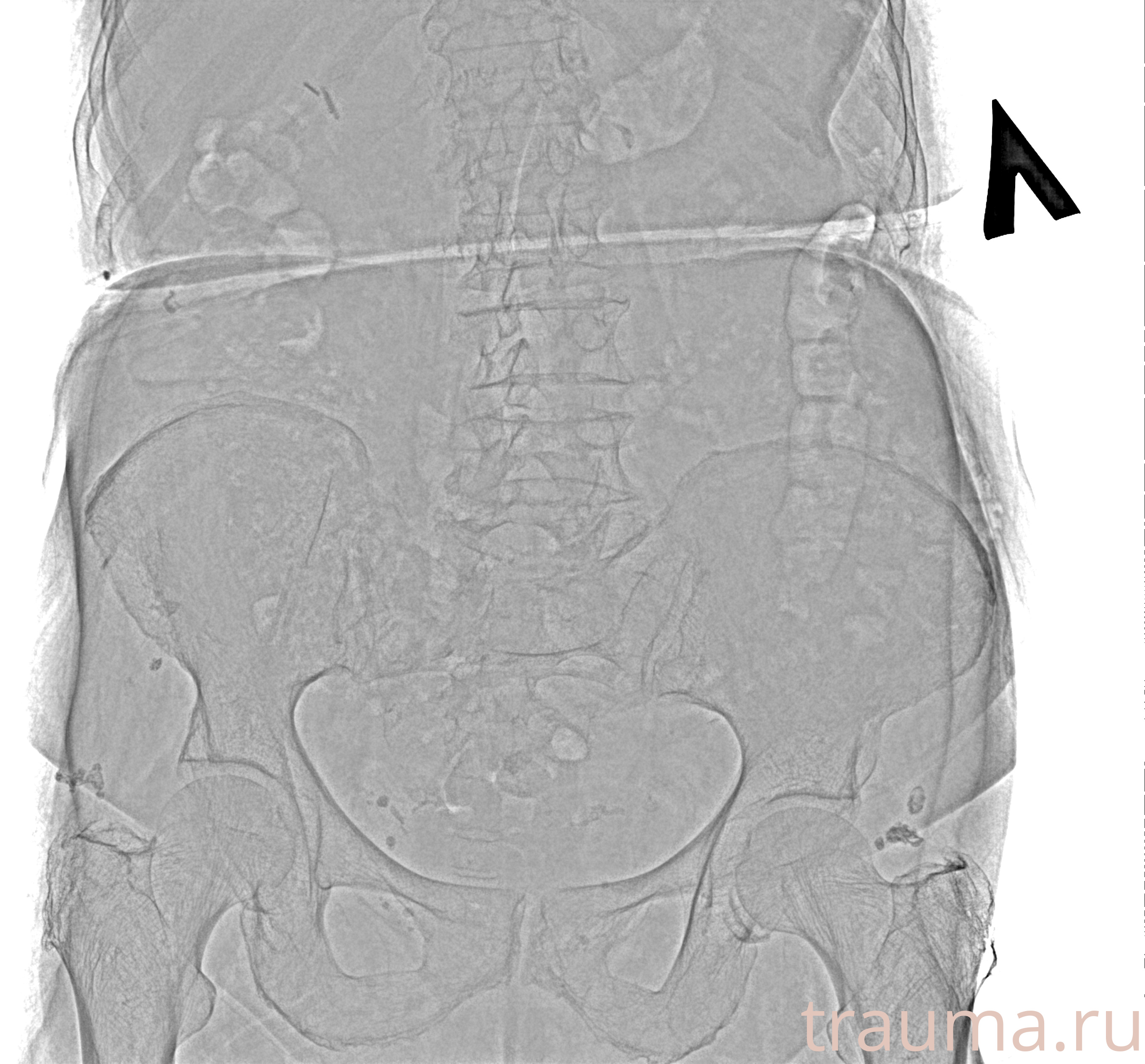 Рентген на дому: по вашему адресу приезжает врач-рентгенолог, травматолог-ортопед с мобильным рентгеновским аппаратом, проводит диагностику травмы или заболевания, делает необходимые рентгенограммы, дает рекомендации по дальнейшему лечению. Получить качественные снимки в домашних условиях возможно благодаря уникальной методике, разработанной МосРентген Центром для института  Склифосовского