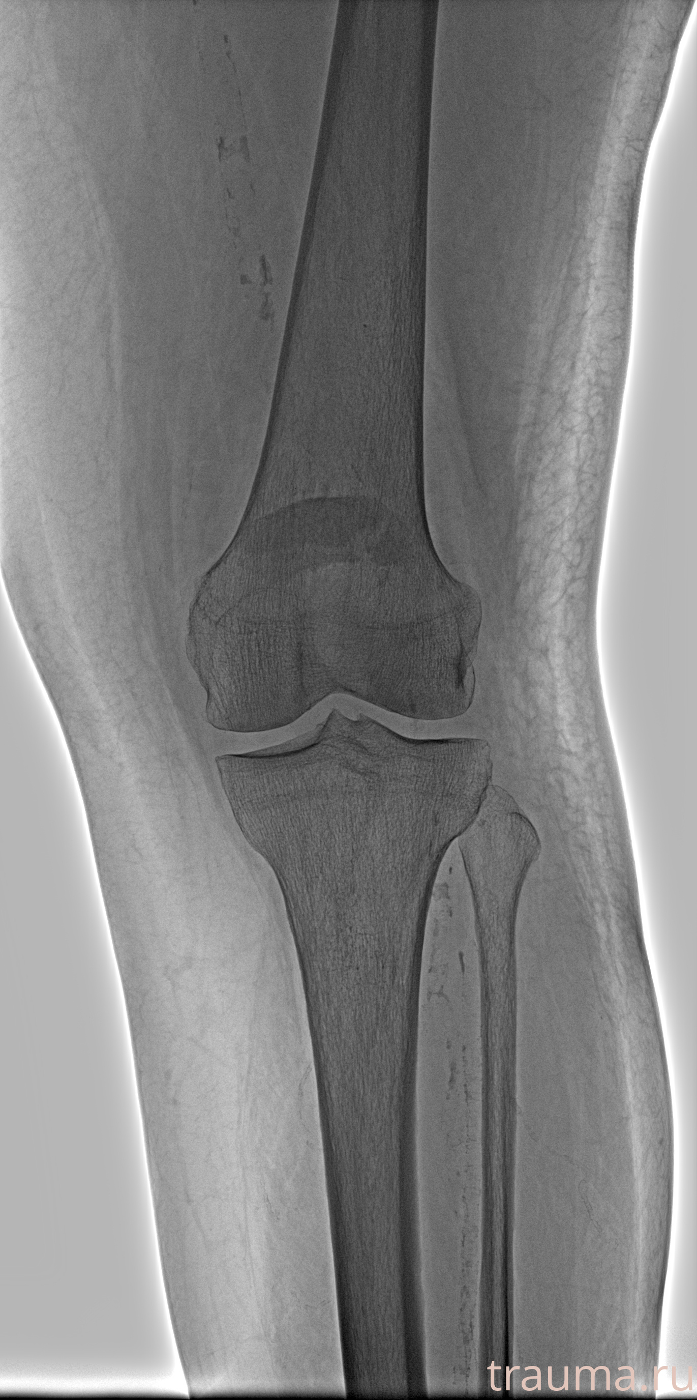 Рентген на дому: по вашему адресу приезжает врач-рентгенолог, травматолог-ортопед с мобильным рентгеновским аппаратом, проводит диагностику травмы или заболевания, делает необходимые рентгенограммы, дает рекомендации по дальнейшему лечению. Получить качественные снимки в домашних условиях возможно благодаря уникальной методике, разработанной МосРентген Центром для института  Склифосовского