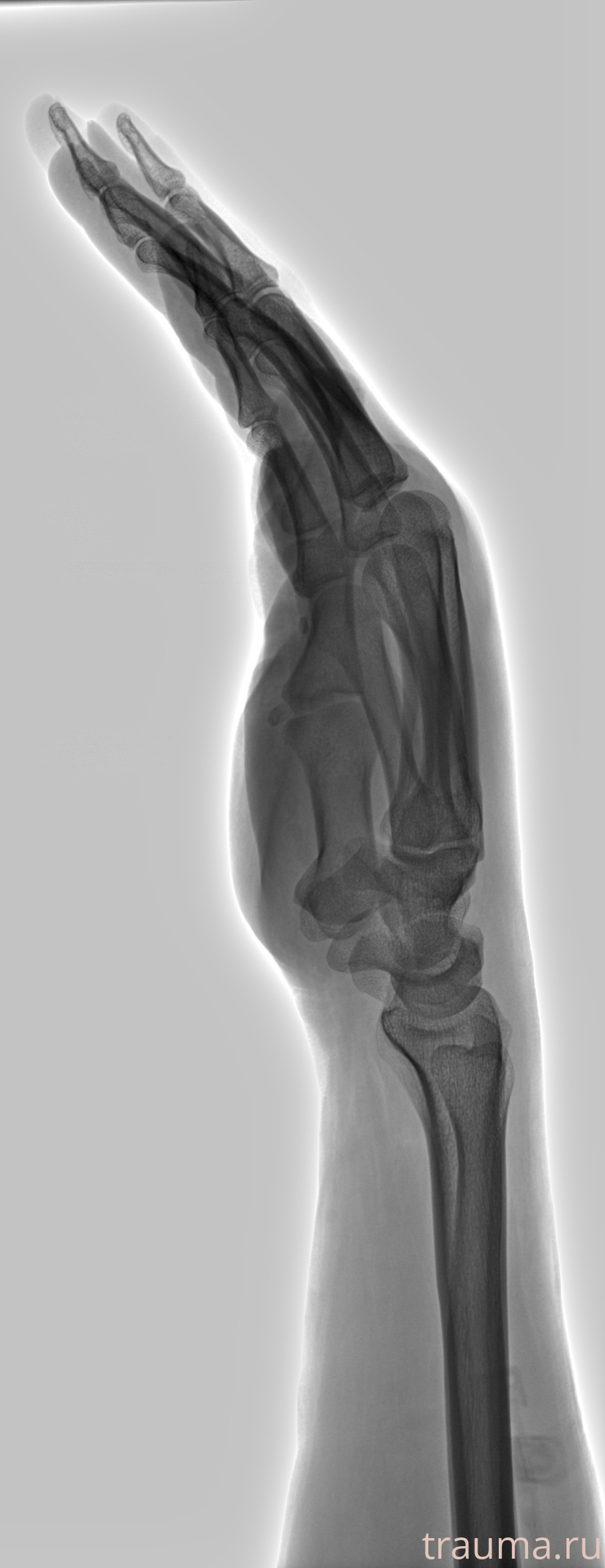 Рентген на дому: по вашему адресу приезжает врач-рентгенолог, травматолог-ортопед с мобильным рентгеновским аппаратом, проводит диагностику травмы или заболевания, делает необходимые рентгенограммы, дает рекомендации по дальнейшему лечению. Получить качественные снимки в домашних условиях возможно благодаря уникальной методике, разработанной МосРентген Центром для института  Склифосовского