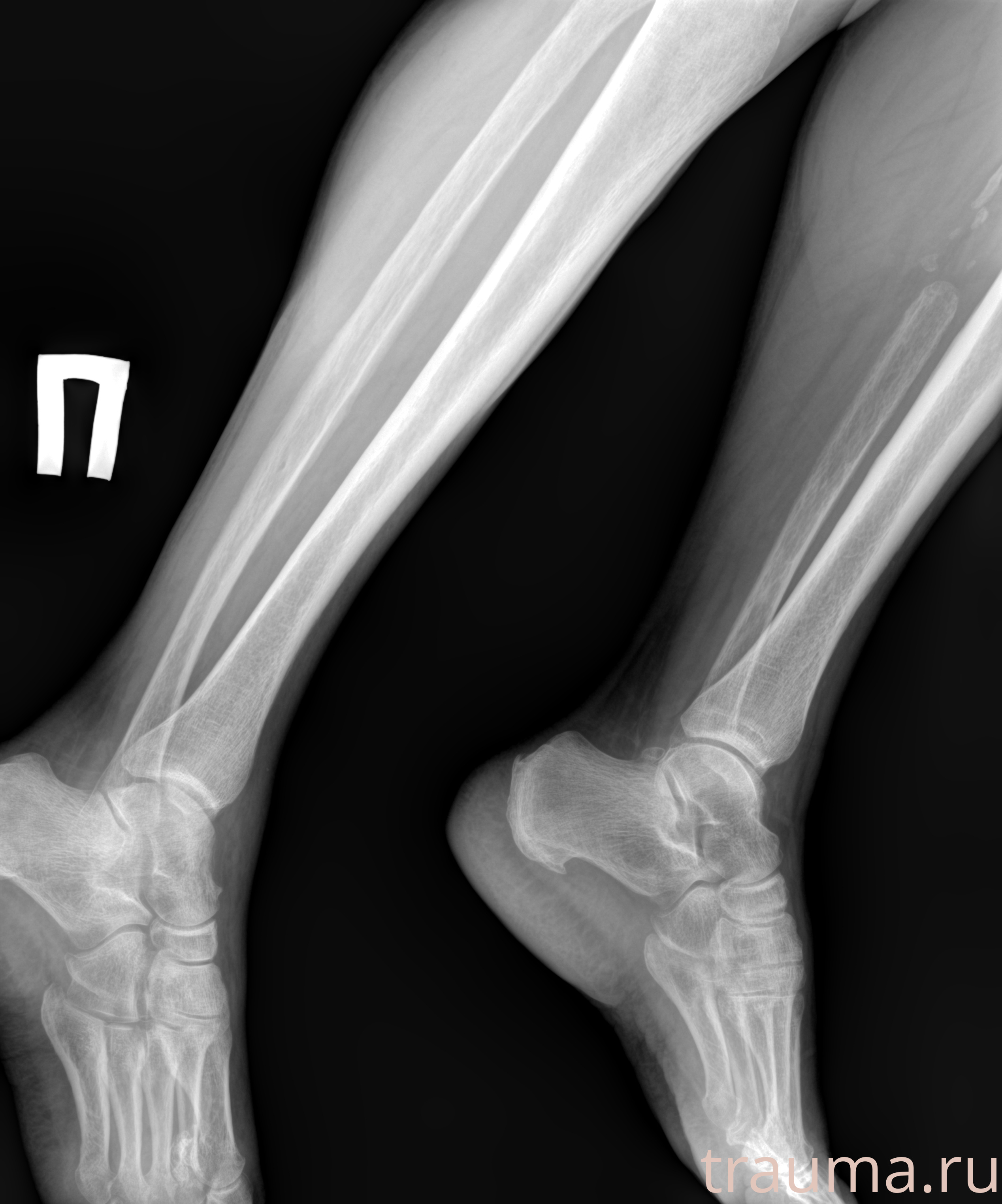 Рентген на дому: по вашему адресу приезжает врач-рентгенолог, травматолог-ортопед с мобильным рентгеновским аппаратом, проводит диагностику травмы или заболевания, делает необходимые рентгенограммы, дает рекомендации по дальнейшему лечению. Получить качественные снимки в домашних условиях возможно благодаря уникальной методике, разработанной МосРентген Центром для института  Склифосовского