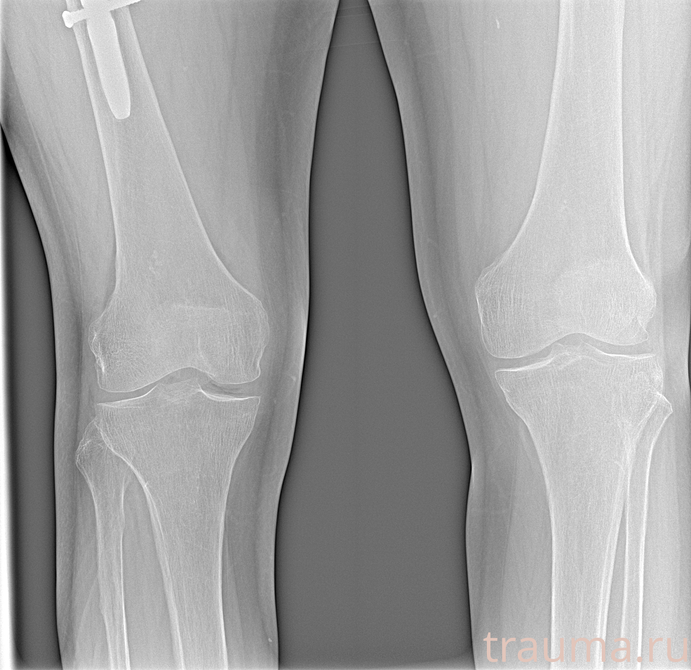 Рентген на дому: по вашему адресу приезжает врач-рентгенолог, травматолог-ортопед с мобильным рентгеновским аппаратом, проводит диагностику травмы или заболевания, делает необходимые рентгенограммы, дает рекомендации по дальнейшему лечению. Получить качественные снимки в домашних условиях возможно благодаря уникальной методике, разработанной МосРентген Центром для института  Склифосовского