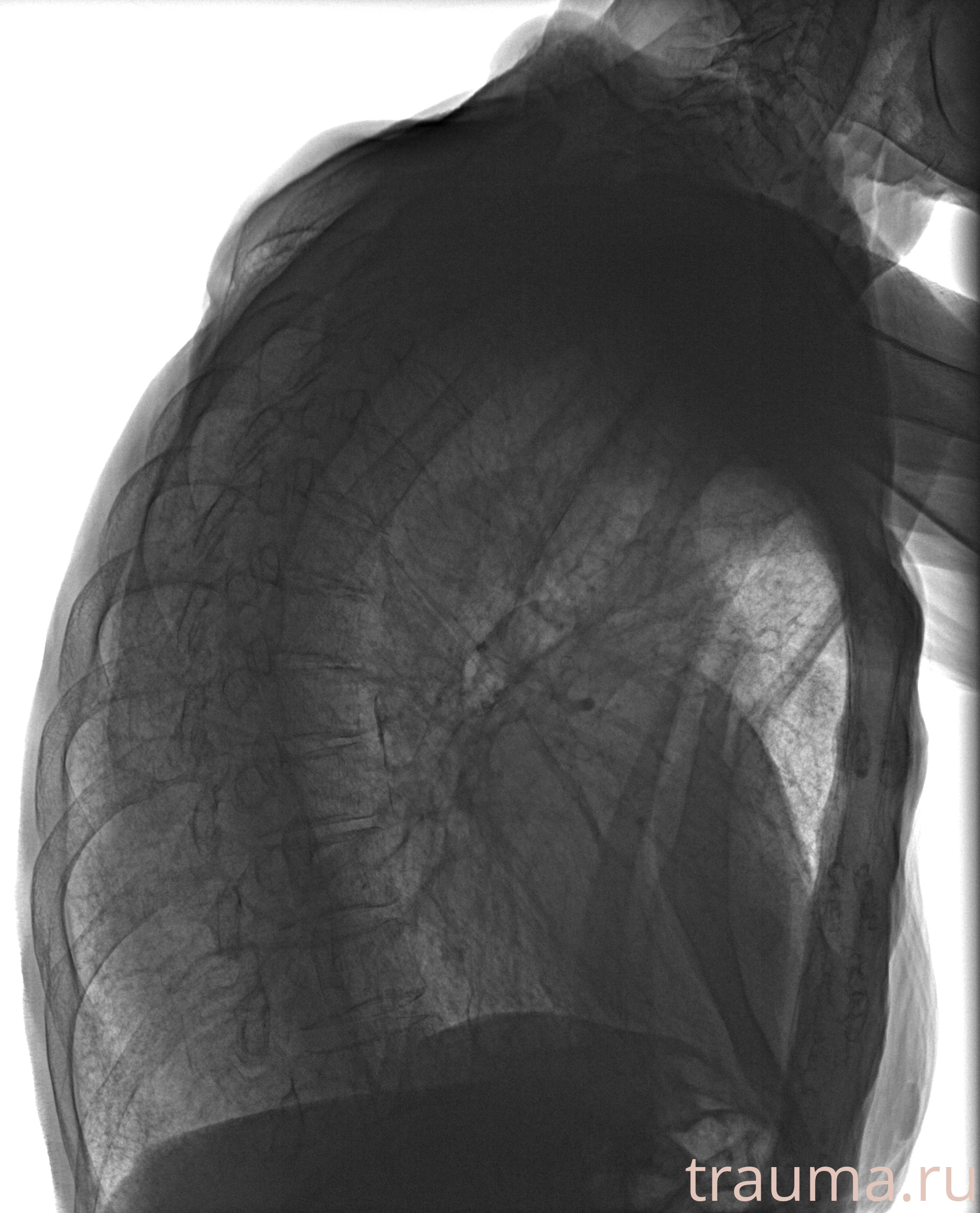 Рентген на дому: по вашему адресу приезжает врач-рентгенолог, травматолог-ортопед с мобильным рентгеновским аппаратом, проводит диагностику травмы или заболевания, делает необходимые рентгенограммы, дает рекомендации по дальнейшему лечению. Получить качественные снимки в домашних условиях возможно благодаря уникальной методике, разработанной МосРентген Центром для института  Склифосовского